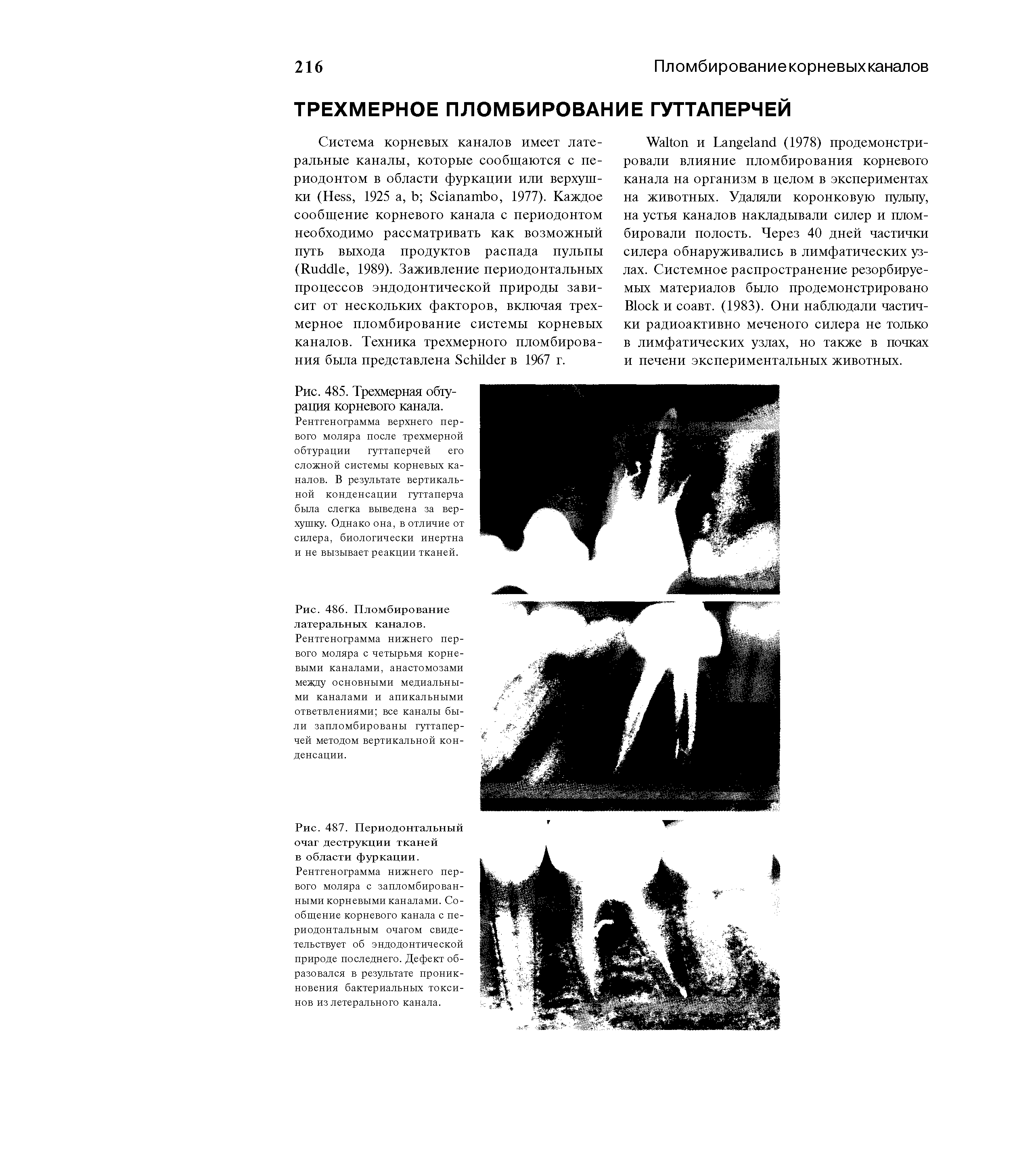 Рис. 485. Трехмерная обтурация корневого канала. Рентгенограмма верхнего первого моляра после трехмерной обтурации гуттаперчей его сложной системы корневых каналов. В результате вертикальной конденсации гуттаперча была слегка выведена за верхушку. Однако она, в отличие от силера, биологически инертна и не вызывает реакции тканей.