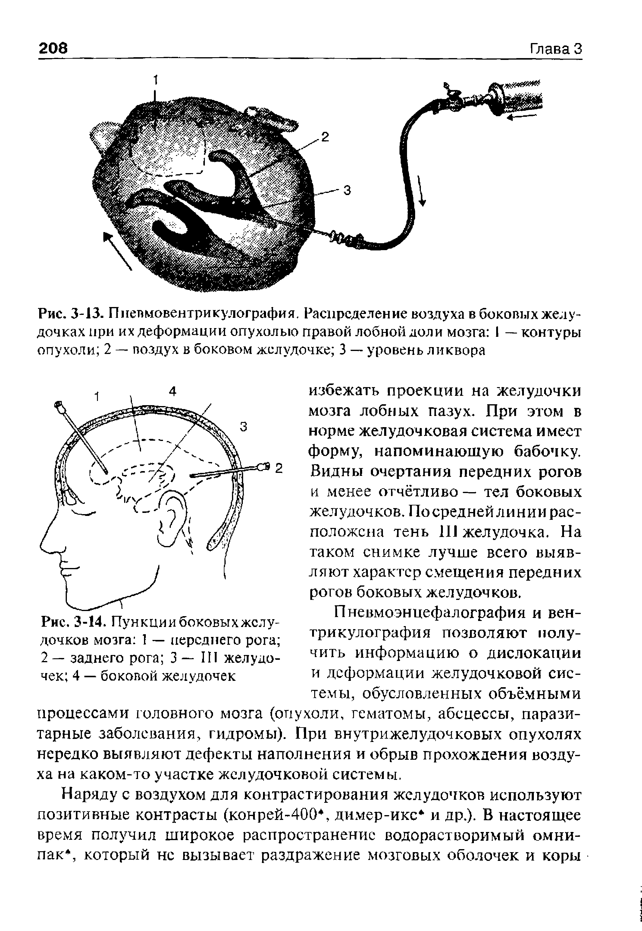 Рис. 3-14. Пункции боковых желудочков мозга 1 — переднего рога 2 — заднего рога 3 — III желудочек 4 — боковой желудочек...