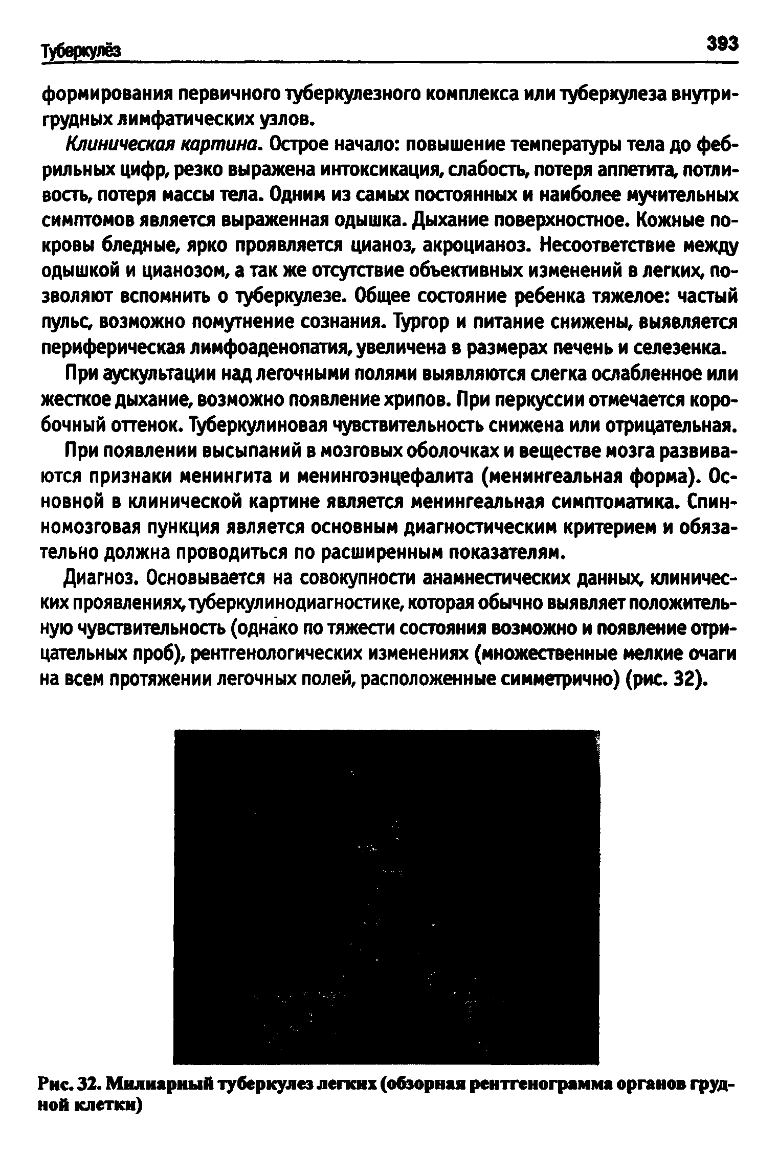 Рис. 32. Милиарный туберкулез легких (обзорная рентгенограмма органов грудной клетки)...