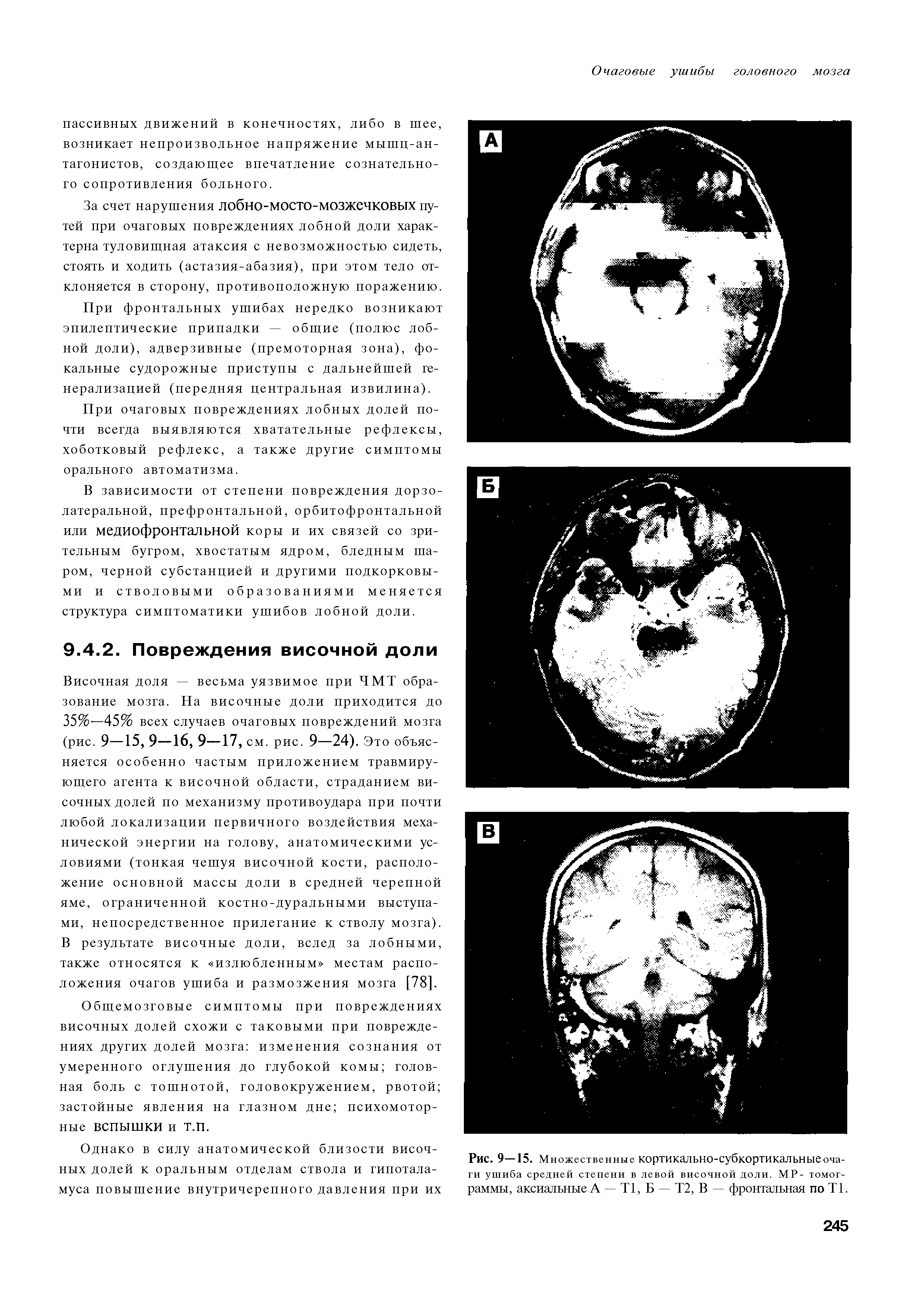 Рис. 9-15. Множественные кортикально-субкортикальныеоча-ги ушиба средней степени в левой височной доли. МР- томог-раммы, аксиальные А — Т1, Б — Т2, В — фронтальная по Т1.