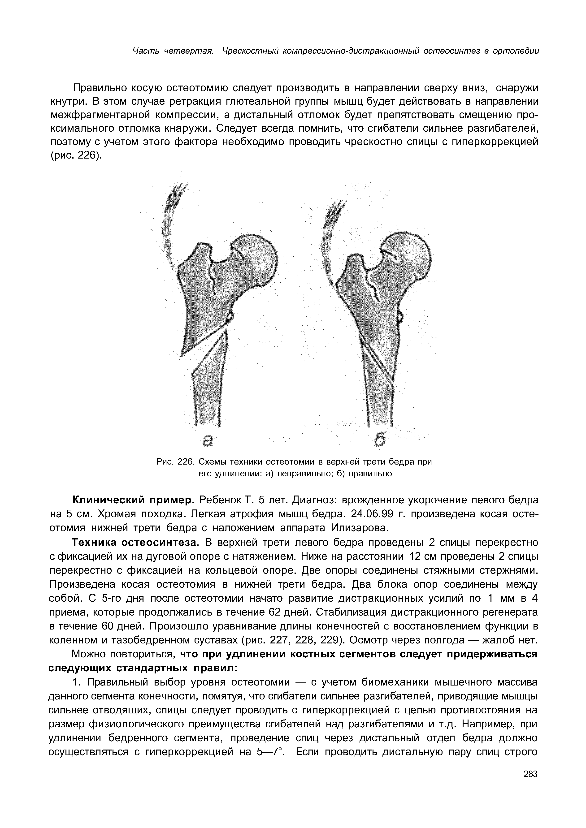 Рис. 226. Схемы техники остеотомии в верхней трети бедра при его удлинении а) неправильно б) правильно...