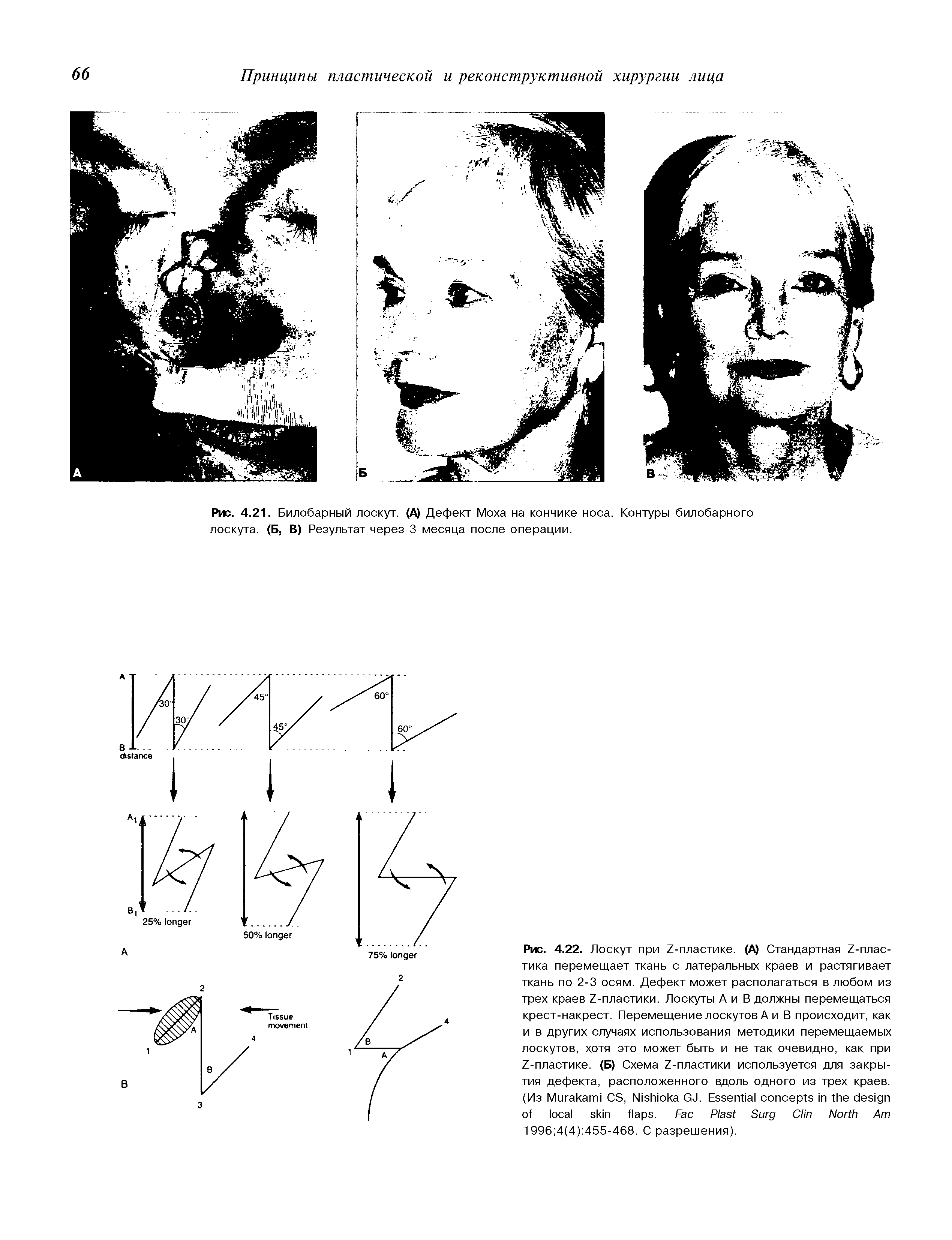 Рис. 4.21. Билобарный лоскут. (А) Дефект Моха на кончике носа. Контуры билобарного лоскута. (Б, В) Результат через 3 месяца после операции.