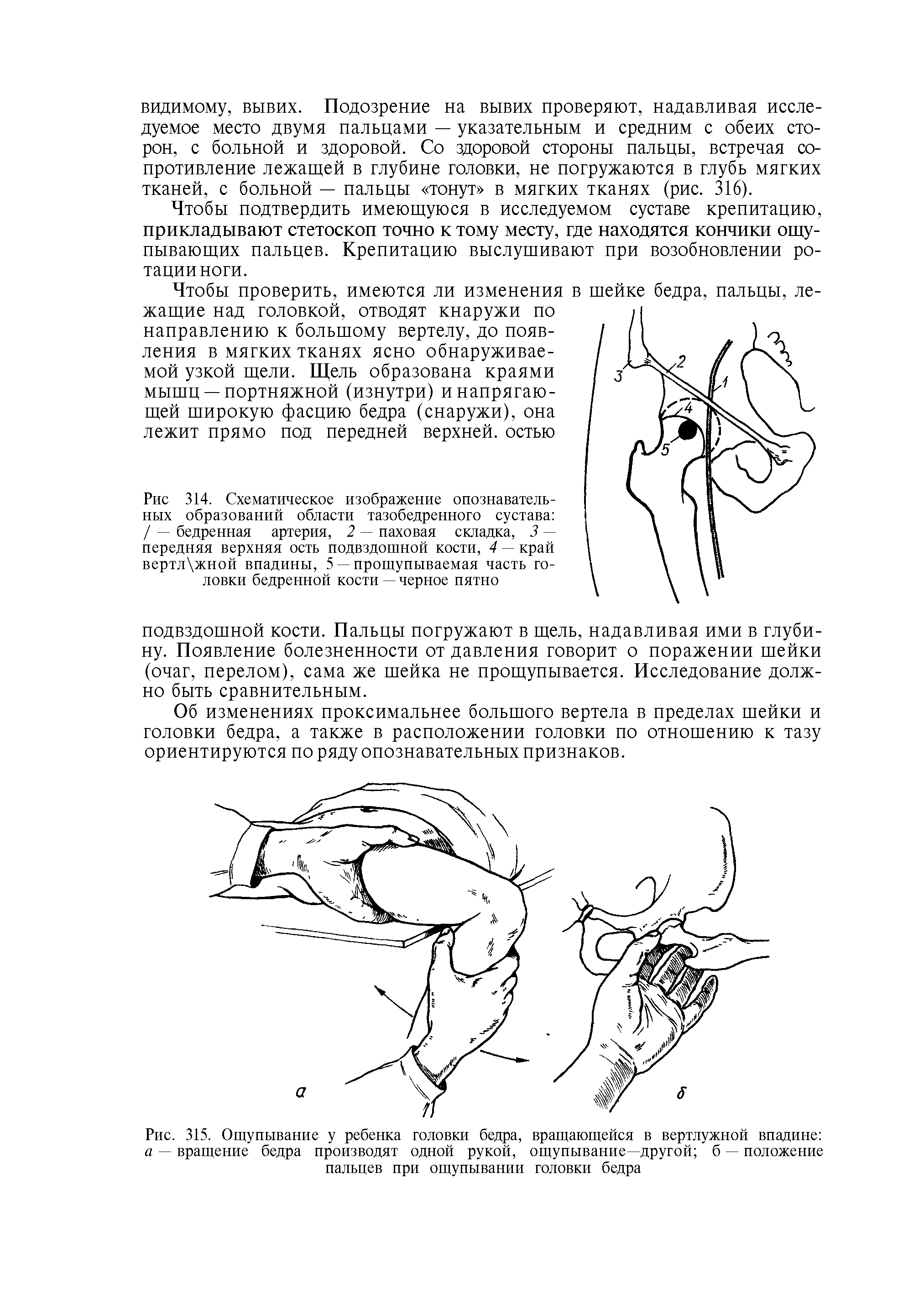 Рис. 315. Ощупывание у ребенка головки бедра, вращающейся в вертлужной впадине а — вращение бедра производят одной рукой, ощупывание—другой б — положение пальцев при ощупывании головки бедра...