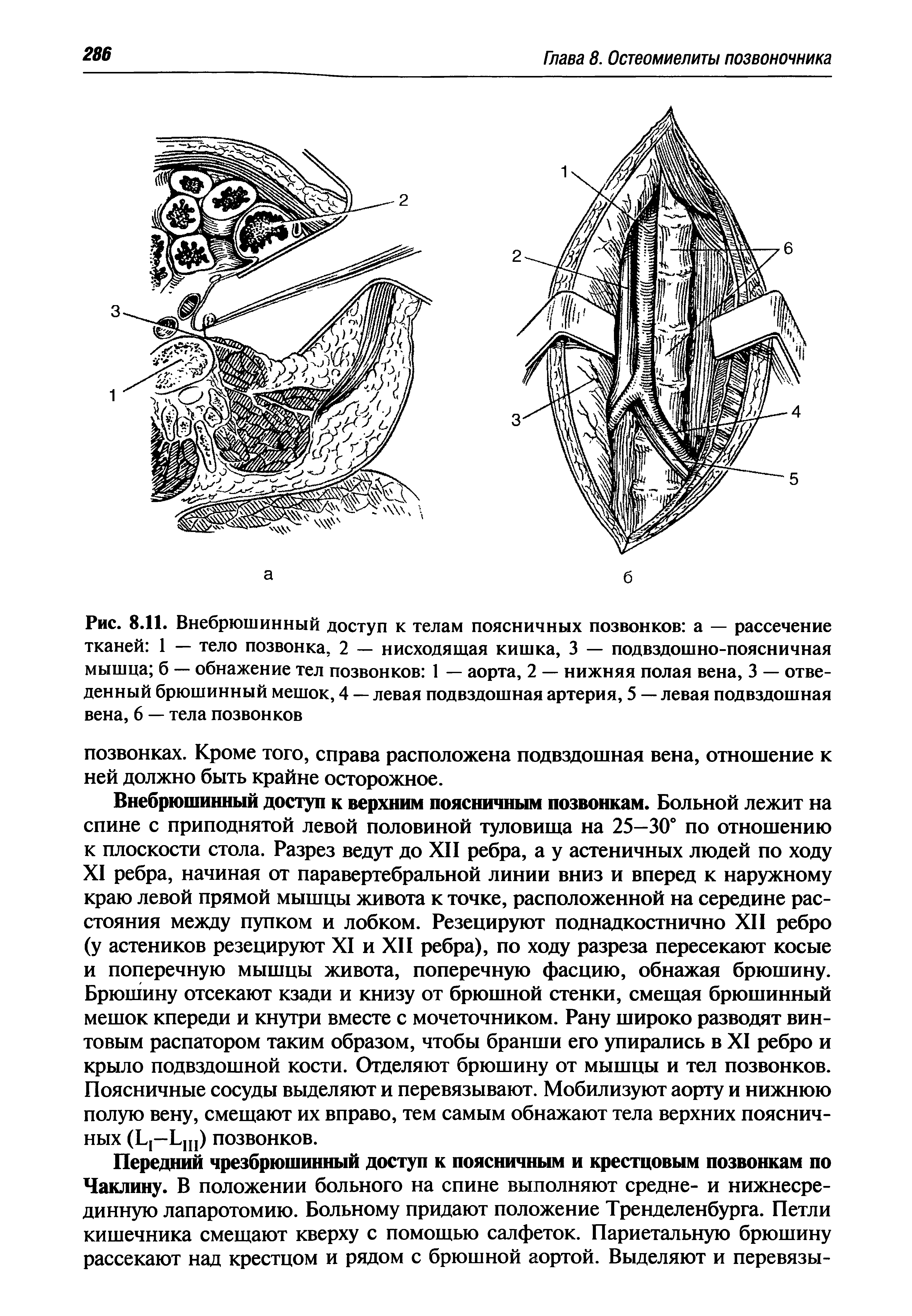 Рис. 8.11. Внебрюшинный доступ к телам поясничных позвонков а — рассечение тканей 1 — тело позвонка. 2 — нисходящая кишка, 3 — подвздошно-поясничная мышца б — обнажение тел позвонков 1 — аорта, 2 — нижняя полая вена, 3 — отведенный брюшинный мешок, 4 — левая подвздошная артерия, 5 — левая подвздошная вена, 6 — тела позвонков...
