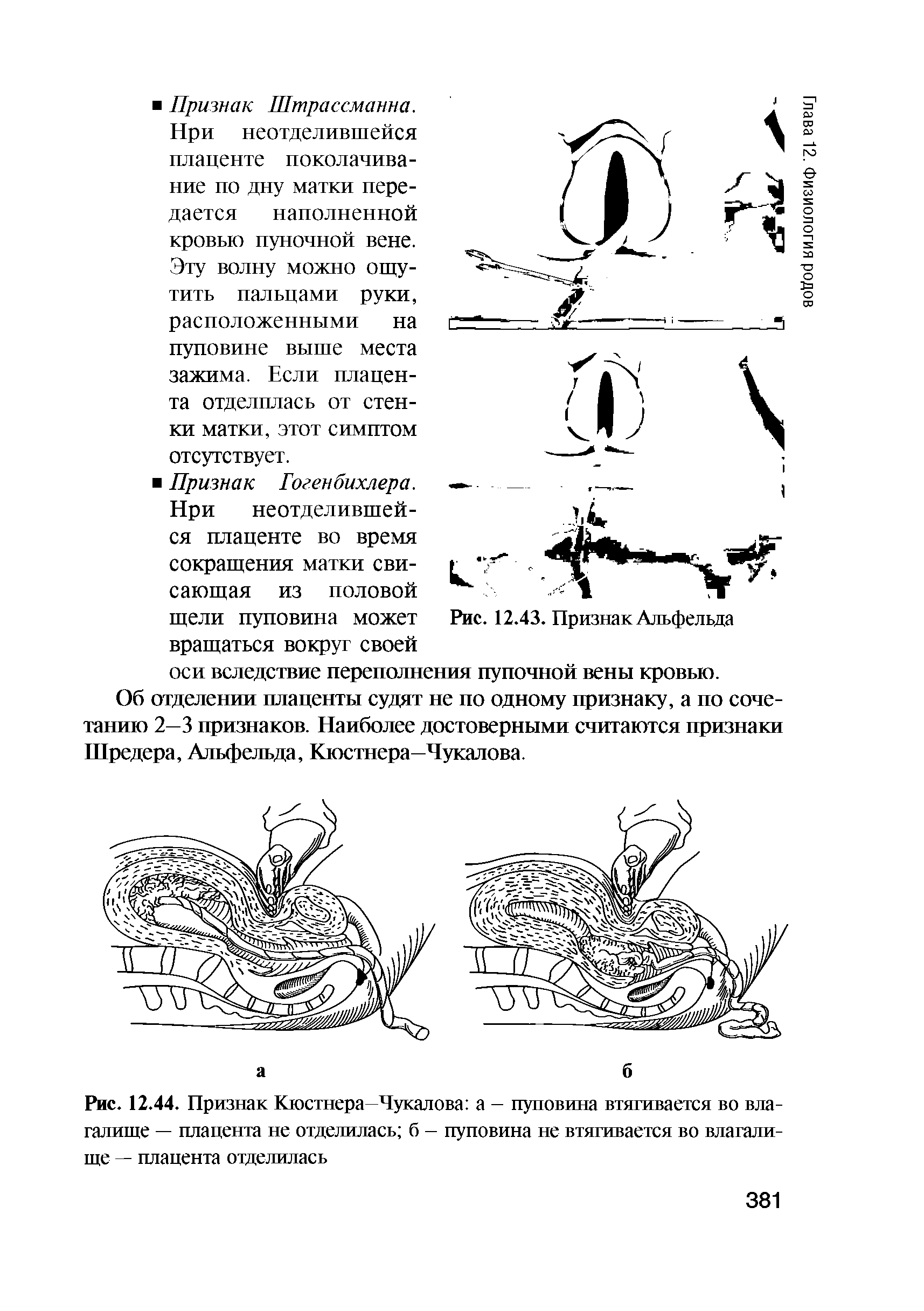 Рис. 12.44. Признак Кюстнера—Чукалова а - пуповина втягивается во влагалище — плацента не отделилась б - пуповина не втягивается во влагалище — плацента отделилась...