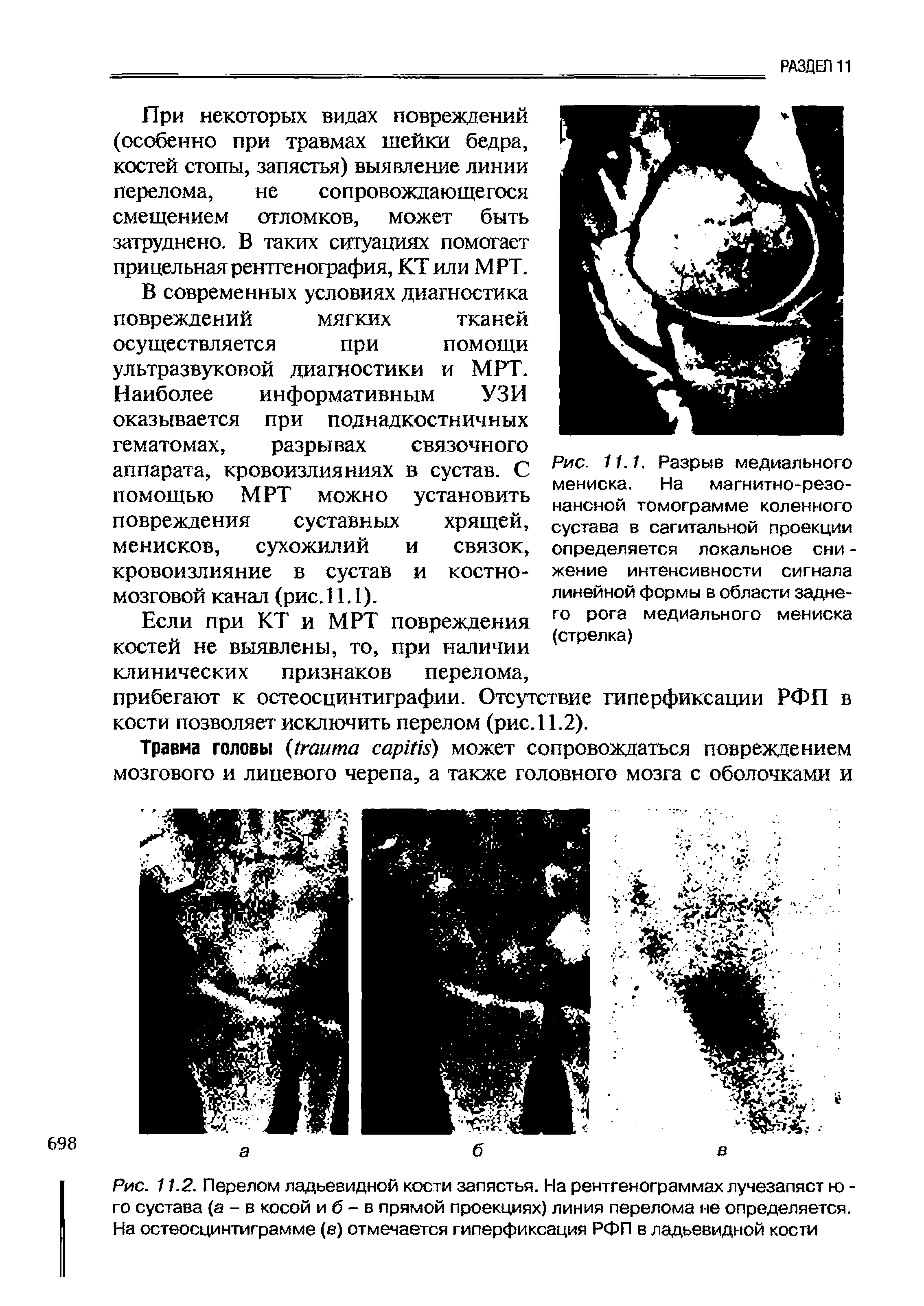 Рис. 11.2. Перелом ладьевидной кости запястья. На рентгенограммах лучезапяст ю -го сустава (а - в косой и б - в прямой проекциях) линия перелома не определяется. На остеосцинтиграмме (в) отмечается гиперфиксация РФП в ладьевидной кости...