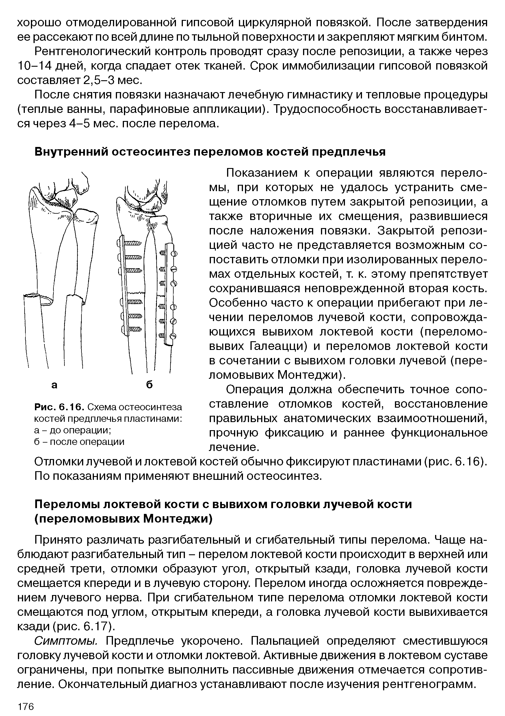 Рис. 6.16. Схема остеосинтеза костей предплечья пластинами а - до операции ...