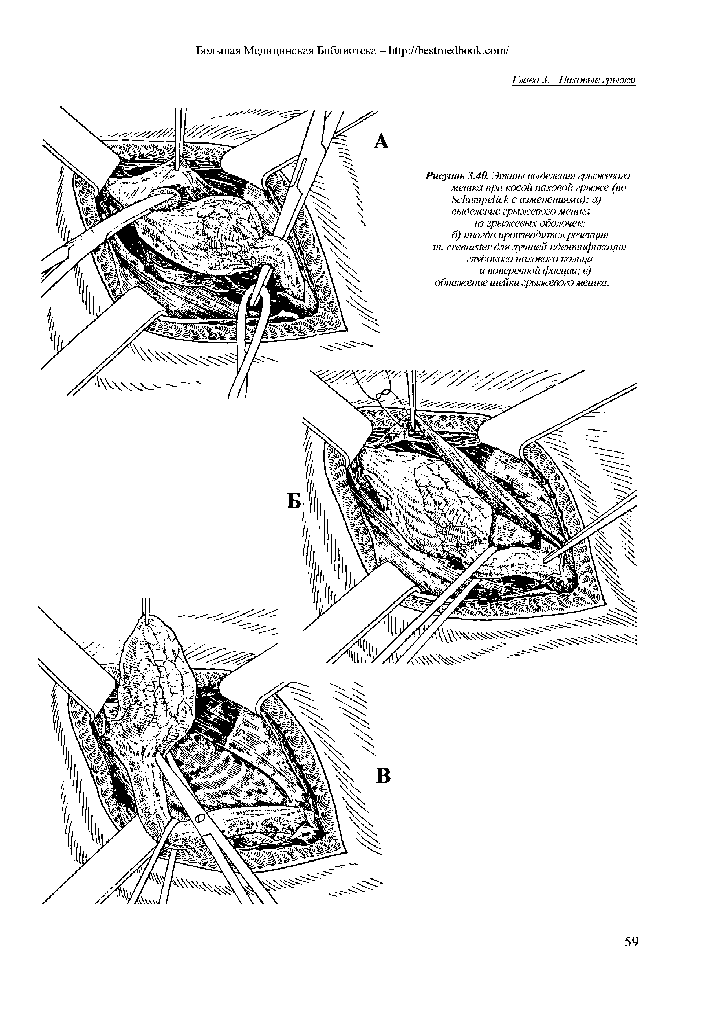 Рисунок 3.40. Этапы выделения грыжевого мешка при косой паховой грыже (по S с изменениями) а) выделение грыжевого мешка из грыжевых оболочек ...