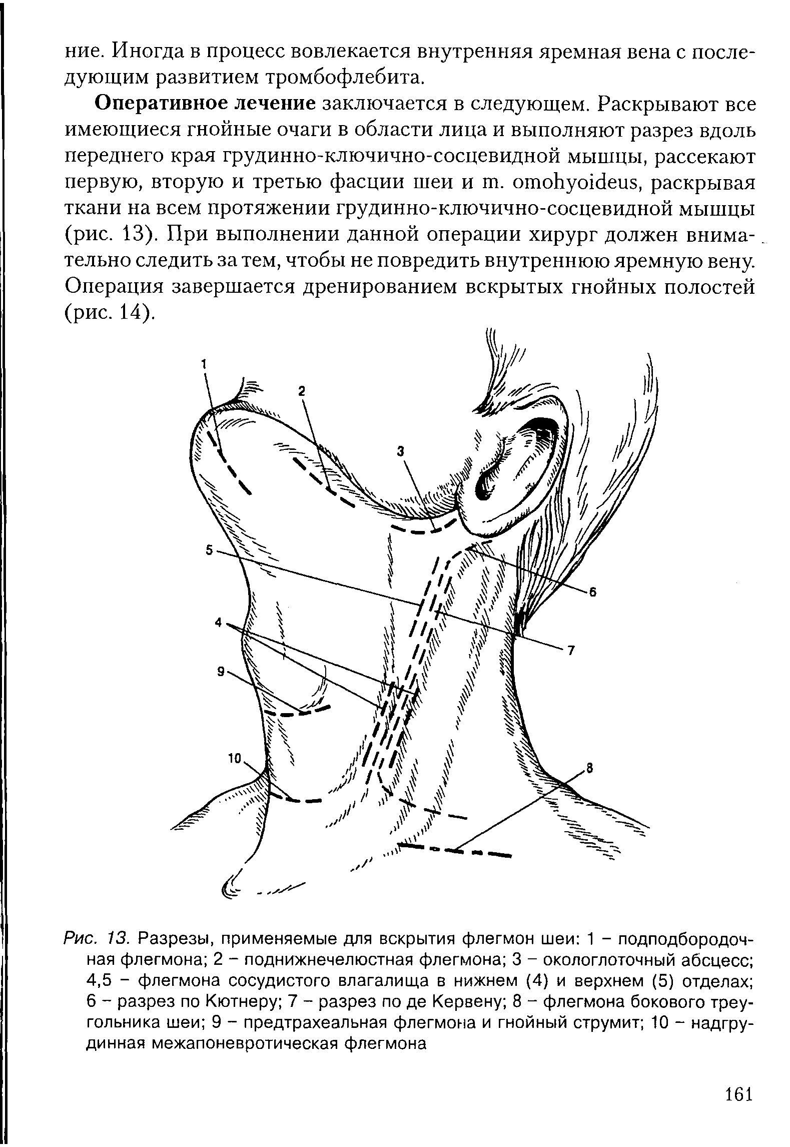 Рис. 13. Разрезы, применяемые для вскрытия флегмон шеи 1 - подподбородочная флегмона 2 - поднижнечелюстная флегмона 3 - окологлоточный абсцесс 4,5 - флегмона сосудистого влагалища в нижнем (4) и верхнем (5) отделах 6 - разрез по Кютнеру 7 - разрез по де Кервену 8 - флегмона бокового треугольника шеи 9 - предтрахеальная флегмона и гнойный струмит 10 - надгрудинная межапоневротическая флегмона...