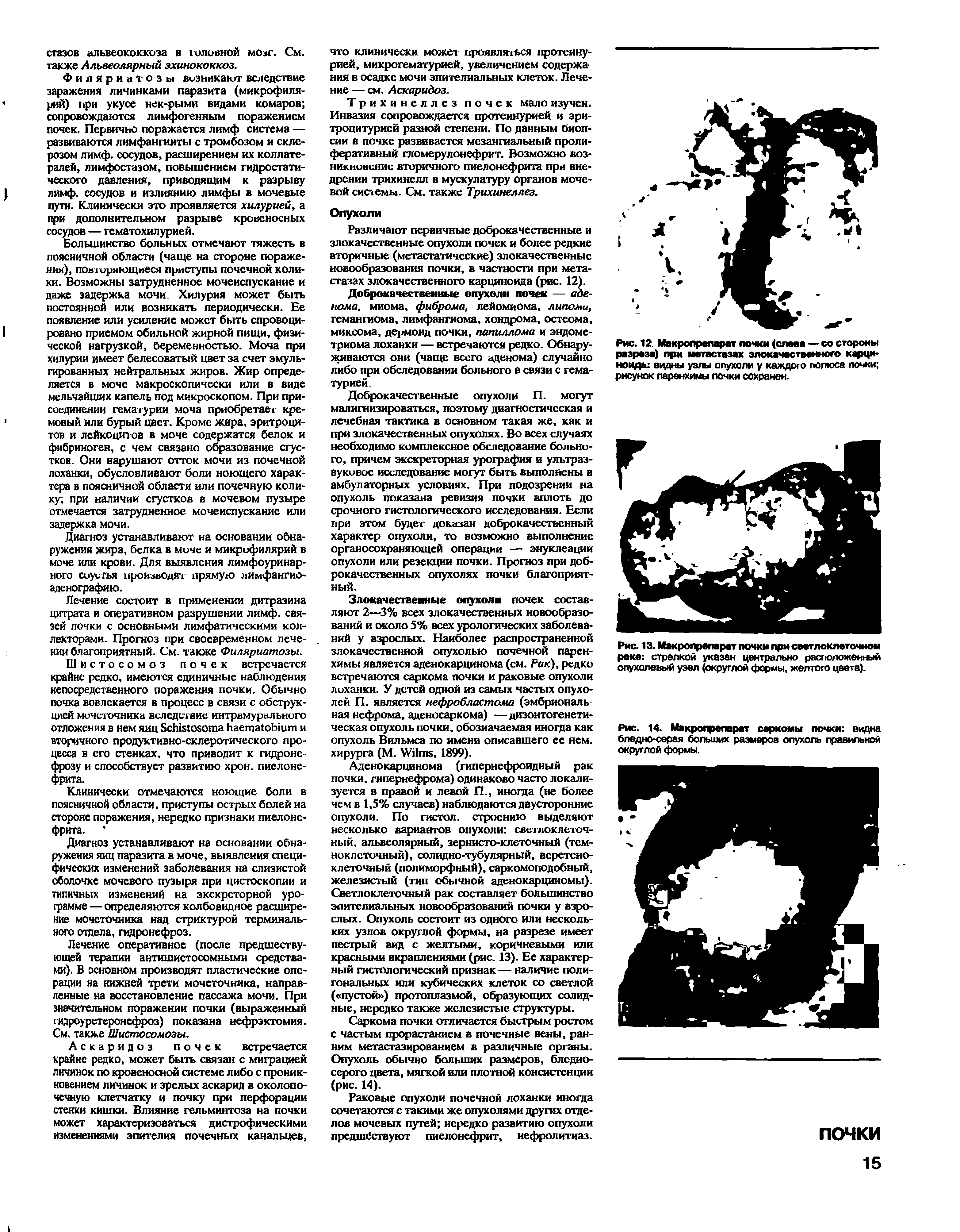 Рис. 14. Макролрепарат саркомы почки видна бледно-серая больших размеров опухоль правильной округлой формы.