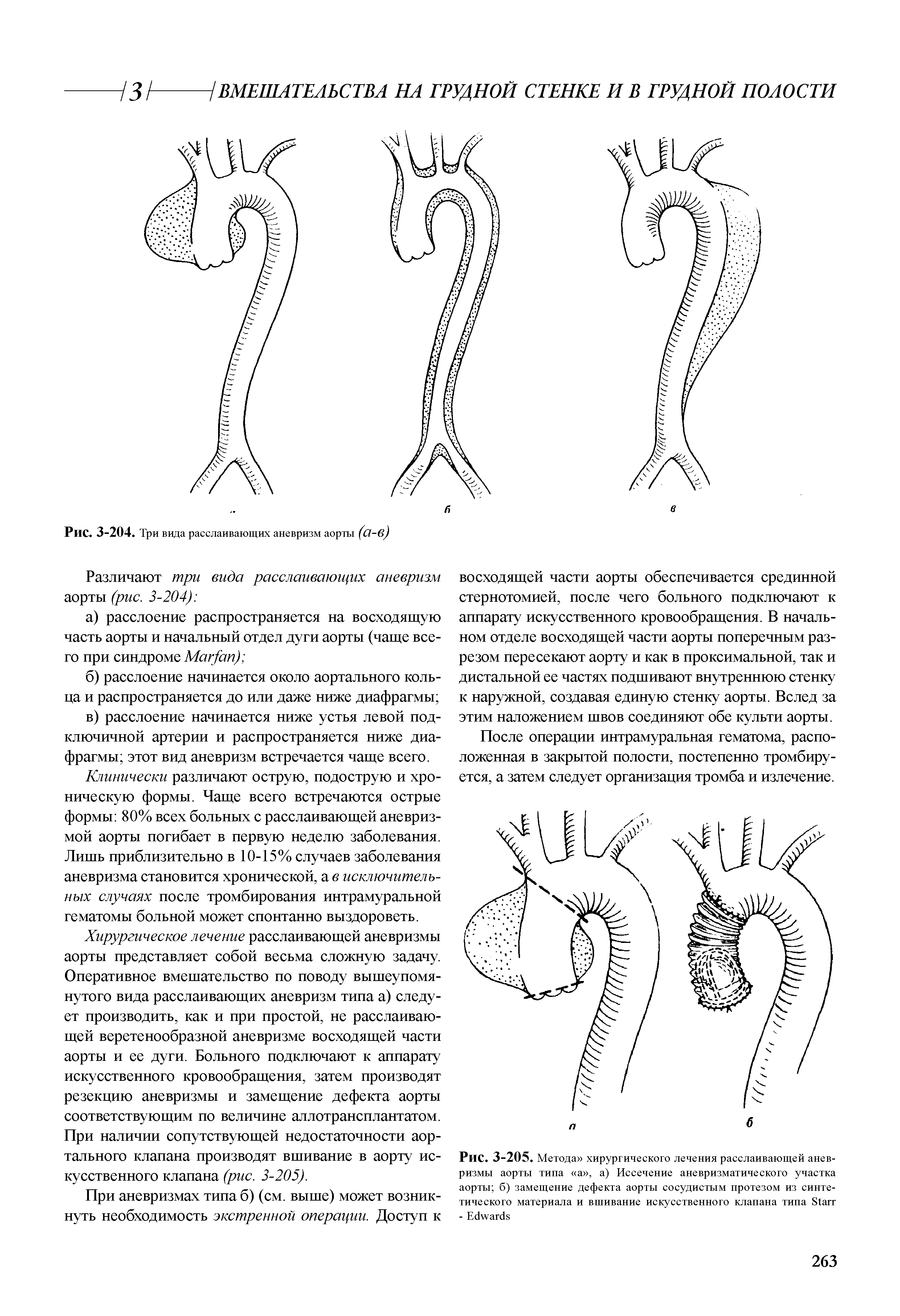 Рис. 3-205. Метода хирургического лечения расслаивающей аневризмы аорты типа а , а) Иссечение аневризматического участка аорты б) замещение дефекта аорты сосудистым протезом из синтетического материала и вшивание искусственного клапана типа S - E ...