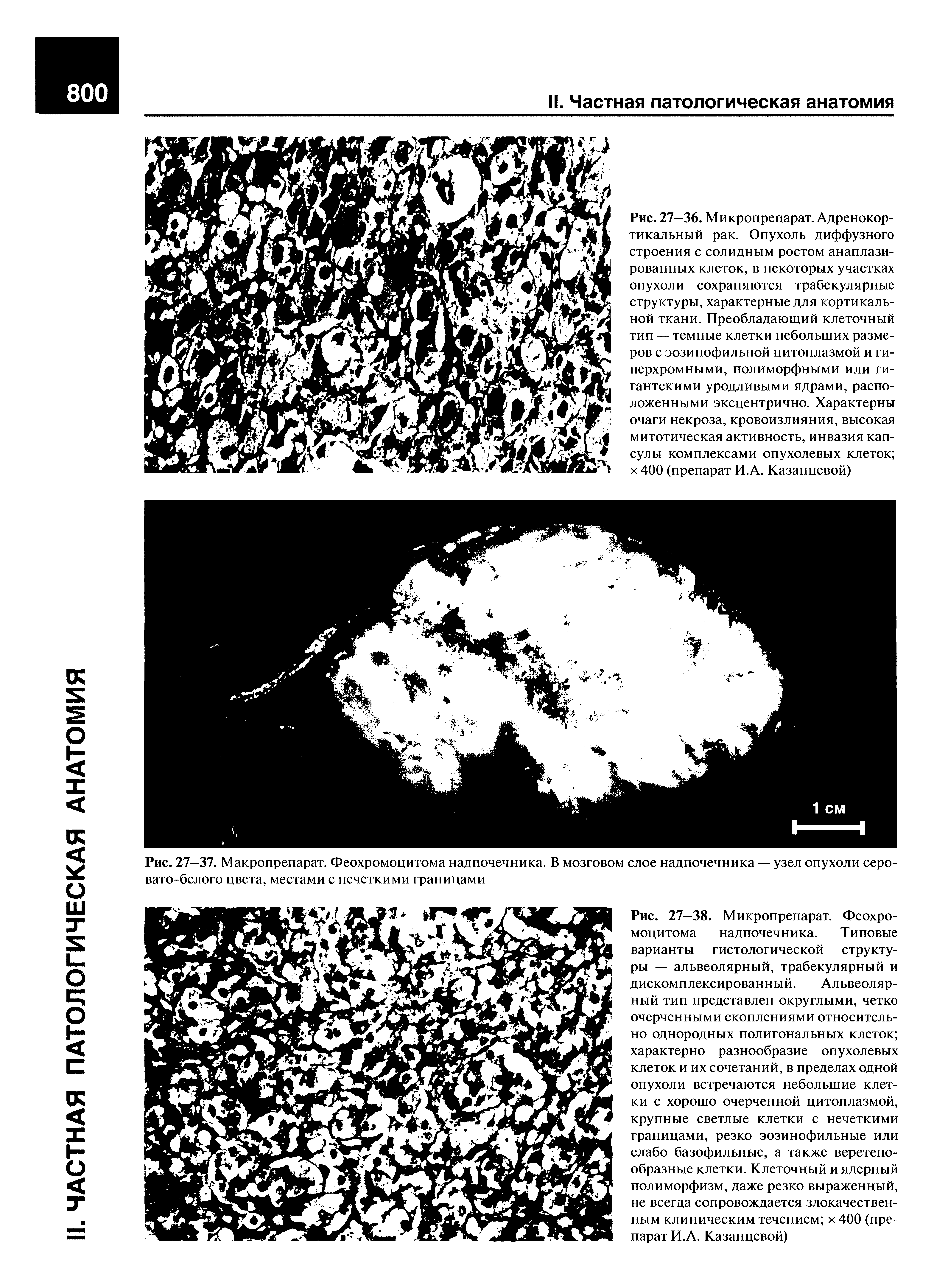 Рис. 27—37. Макропрепарат. Феохромоцитома надпочечника. В мозговом слое надпочечника — узел опухоли серовато-белого цвета, местами с нечеткими границами...