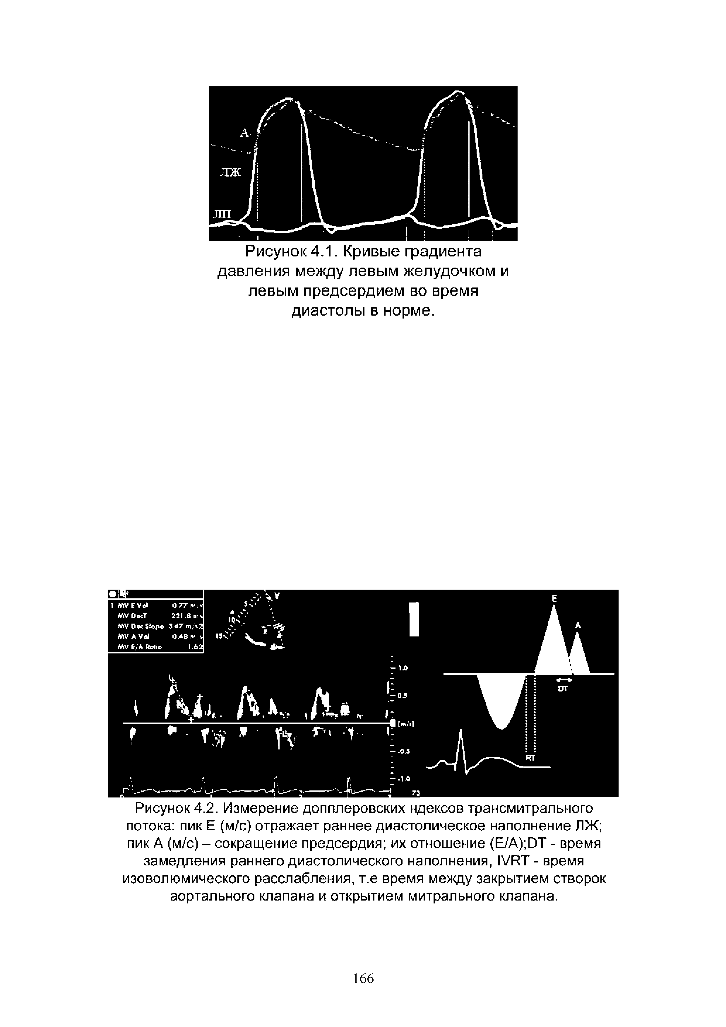 Рисунок 4.2. Измерение допплеровских ндексов трансмитрального потока пик Е (м/с) отражает раннее диастолическое наполнение ЛЖ пик А (м/с) - сокращение предсердия их отношение (Е/А) ОТ - время замедления раннего диастолического наполнения, 1 /РТ - время изоволюмического расслабления, т.е время между закрытием створок...