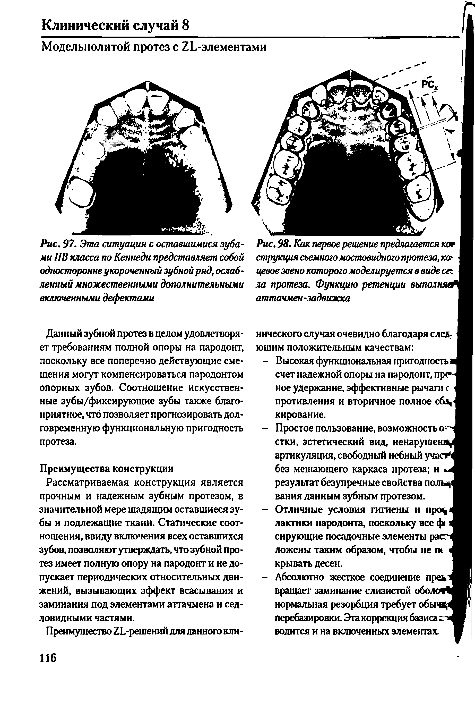 Рис. 98. Как первое решение предлагается каг струкция съемного мостовидного протеза, кок ирвое звено которого моделируется в виде са ла протеза. Функцию ретенции выполнял аттачмен-задвижка...