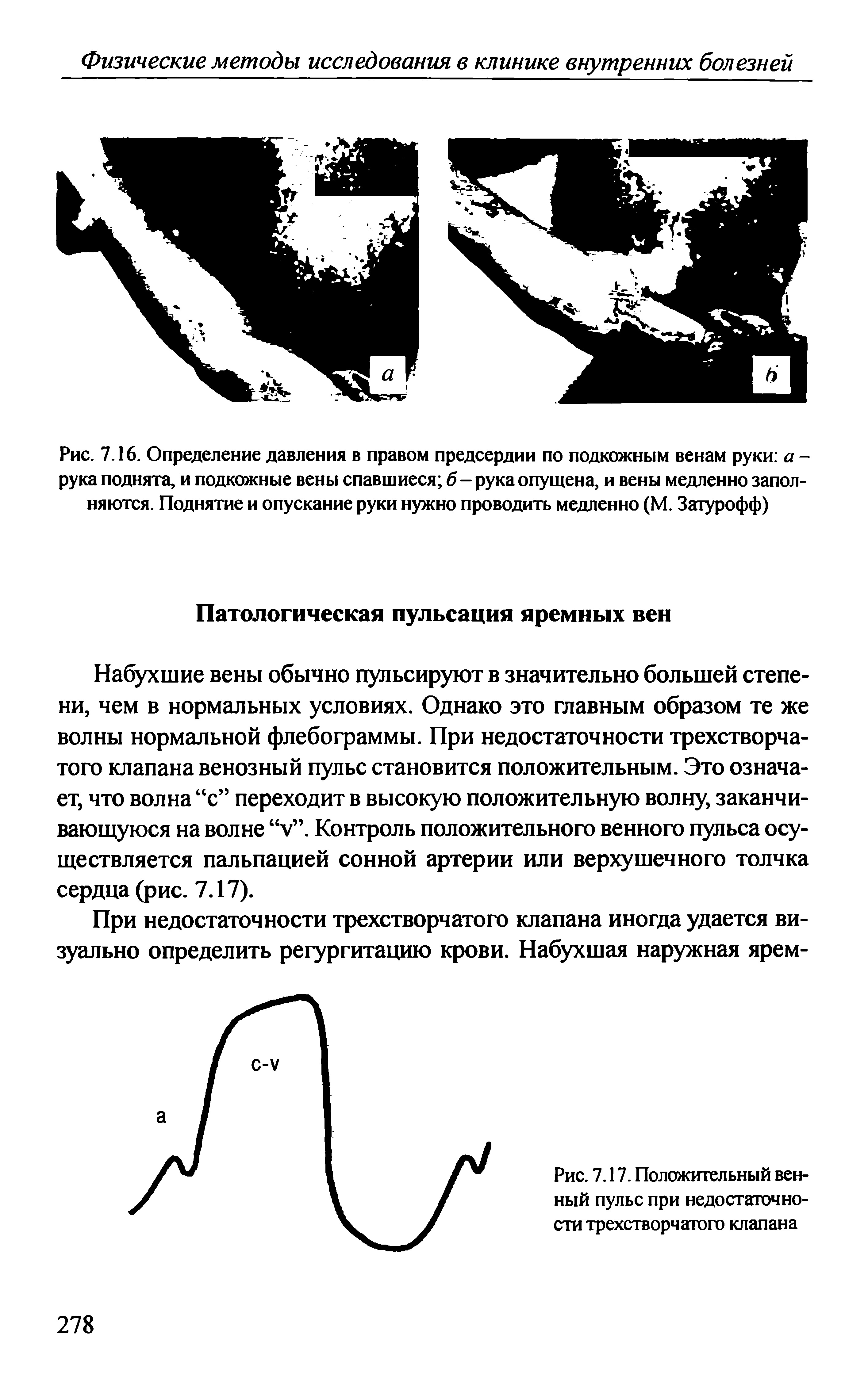 Рис. 7.16. Определение давления в правом предсердии по подкожным венам руки а -рука поднята, и подкожные вены спавшиеся б - рука опущена, и вены медленно заполняются. Поднятие и опускание руки нужно проводить медленно (М. Затурофф)...