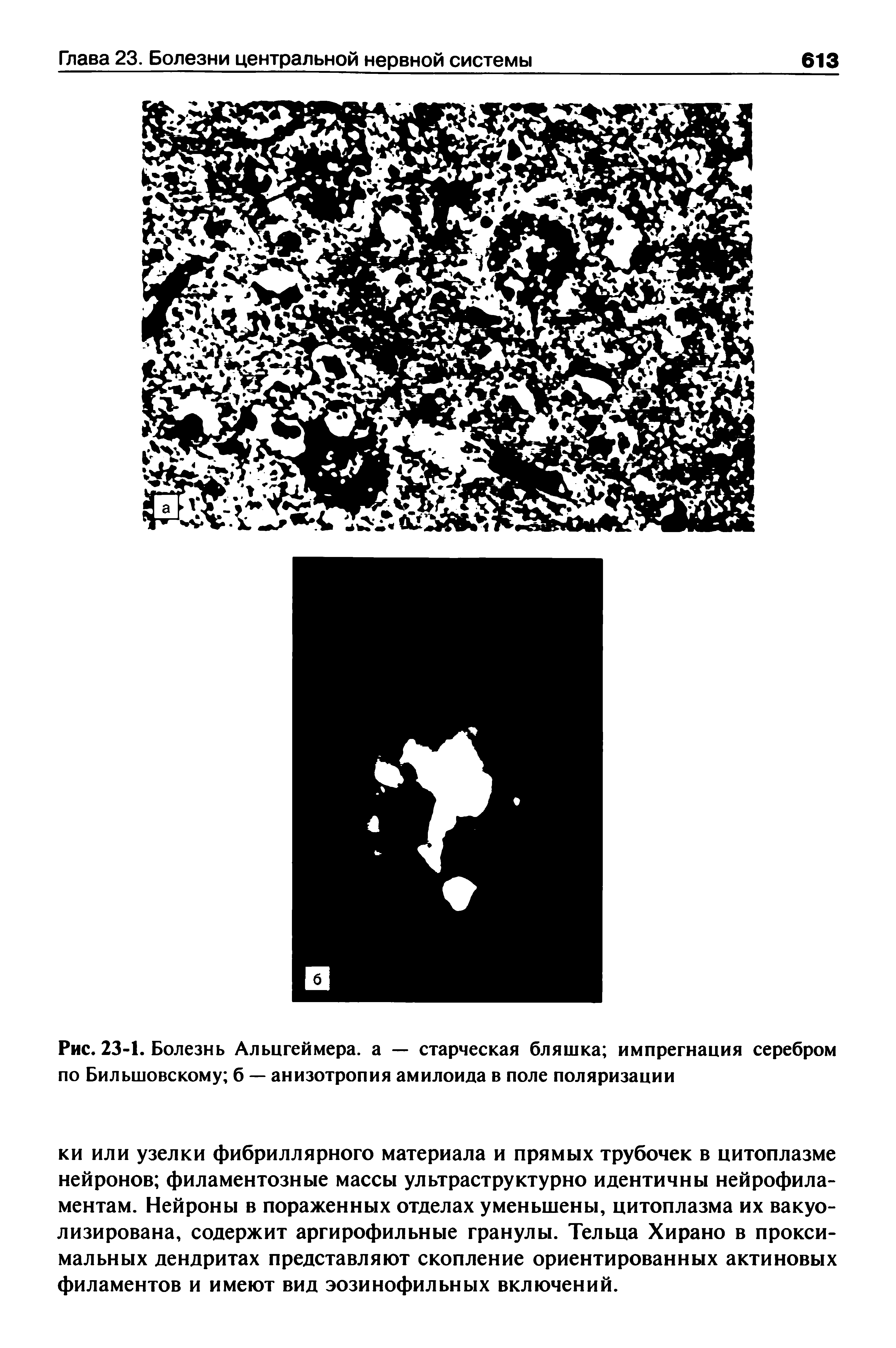 Рис. 23-1. Болезнь Альцгеймера, а — старческая бляшка импрегнация серебром по Бильшовскому б — анизотропия амилоида в поле поляризации...