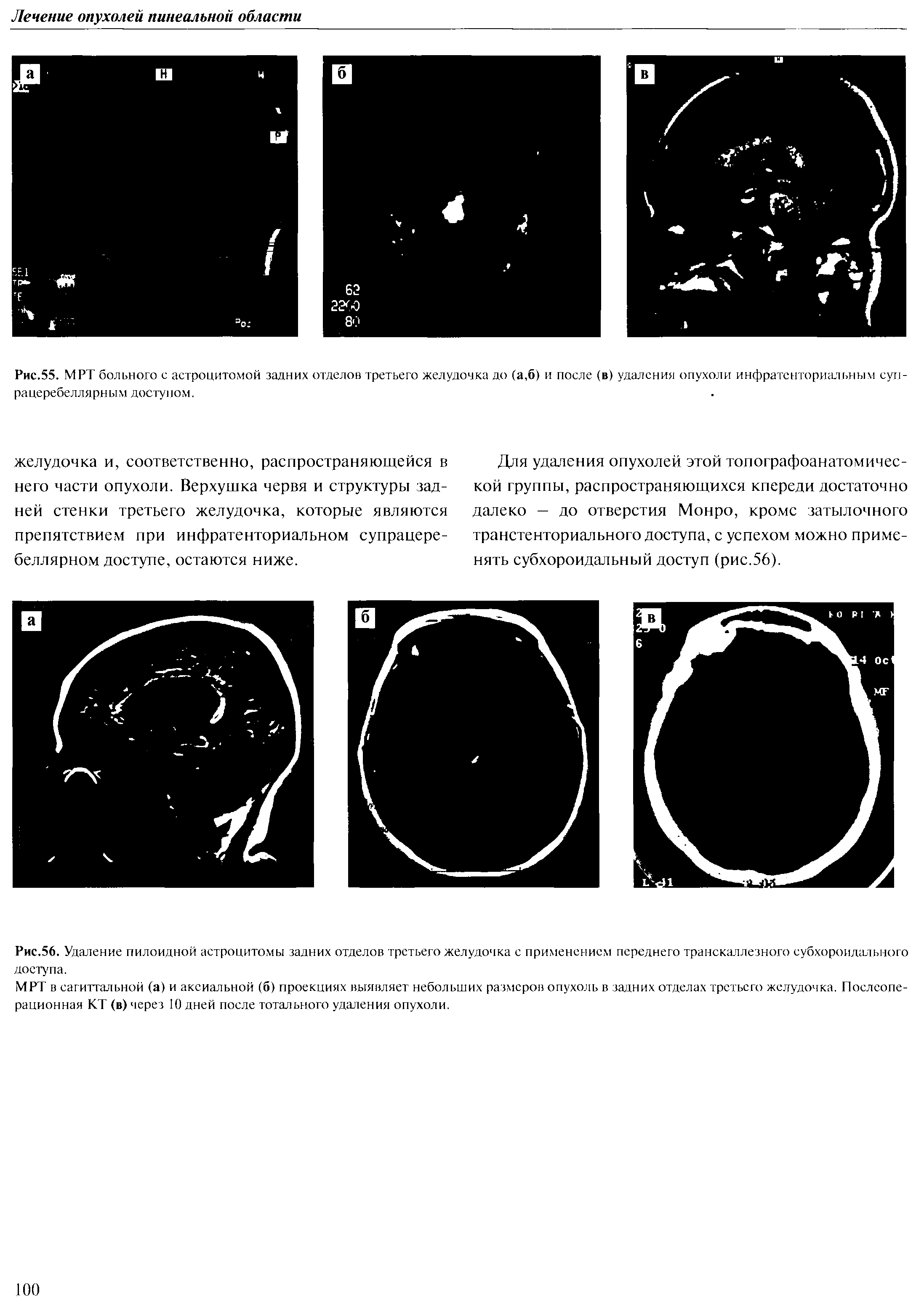 Рис.55. МРТ больного с астроцитомой задних отделов третьего желудочка до (а,б) и после (в) удаления опухоли инфратенториальным сун-рацеребеллярным доступом.