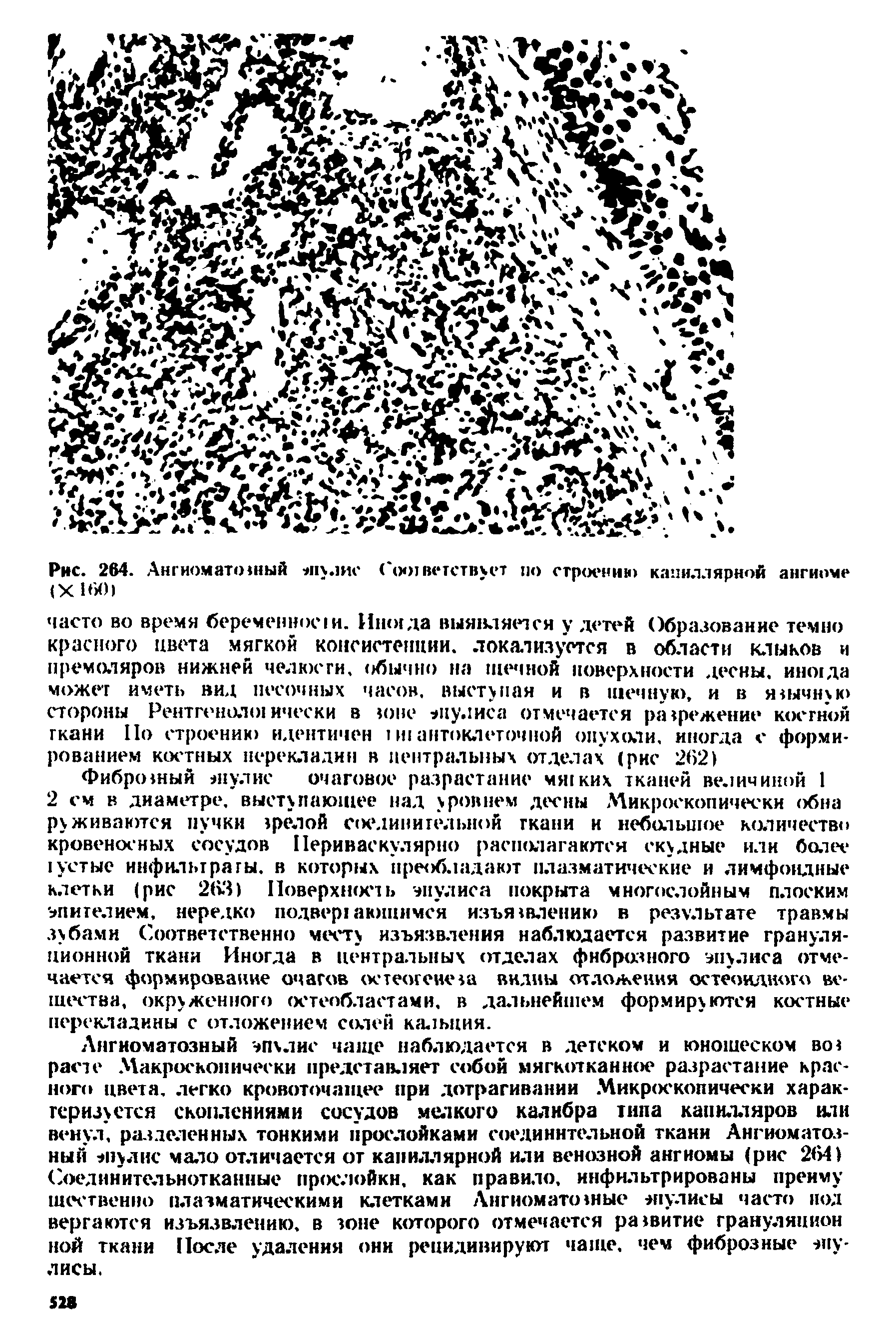 Рис. 264. Ангиоматоишй эпулис ( ояветствует по стрсх-ни ) капиллярной ангиоме (X 160)...