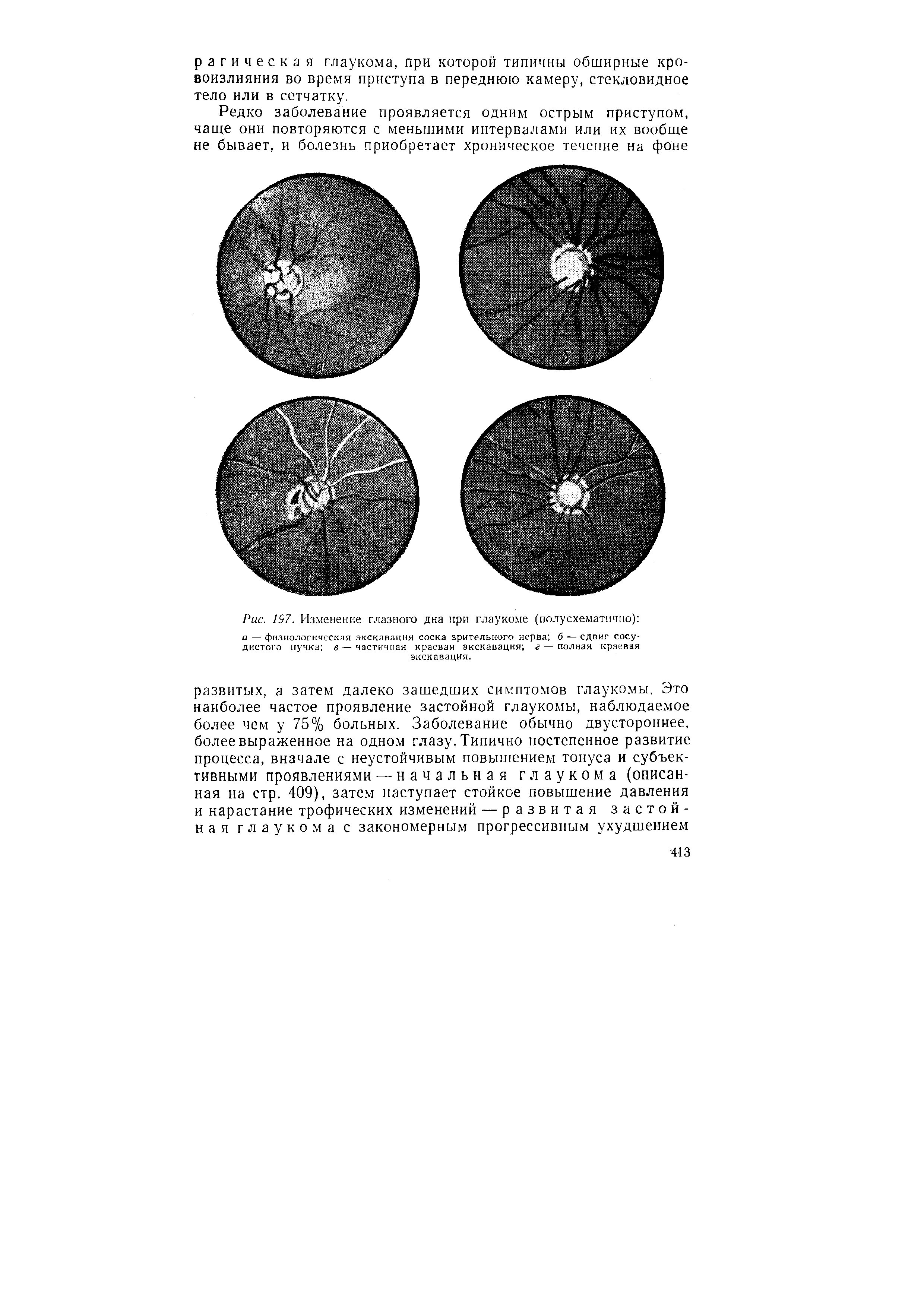 Рис. 197. Изменение глазного дна при глаукоме (полусхематнчно) а — физиологическая экскавация соска зрительного нерва б — сдвиг сосудистого пучка в — частичная краевая экскавация г — полная краевая экскавация.