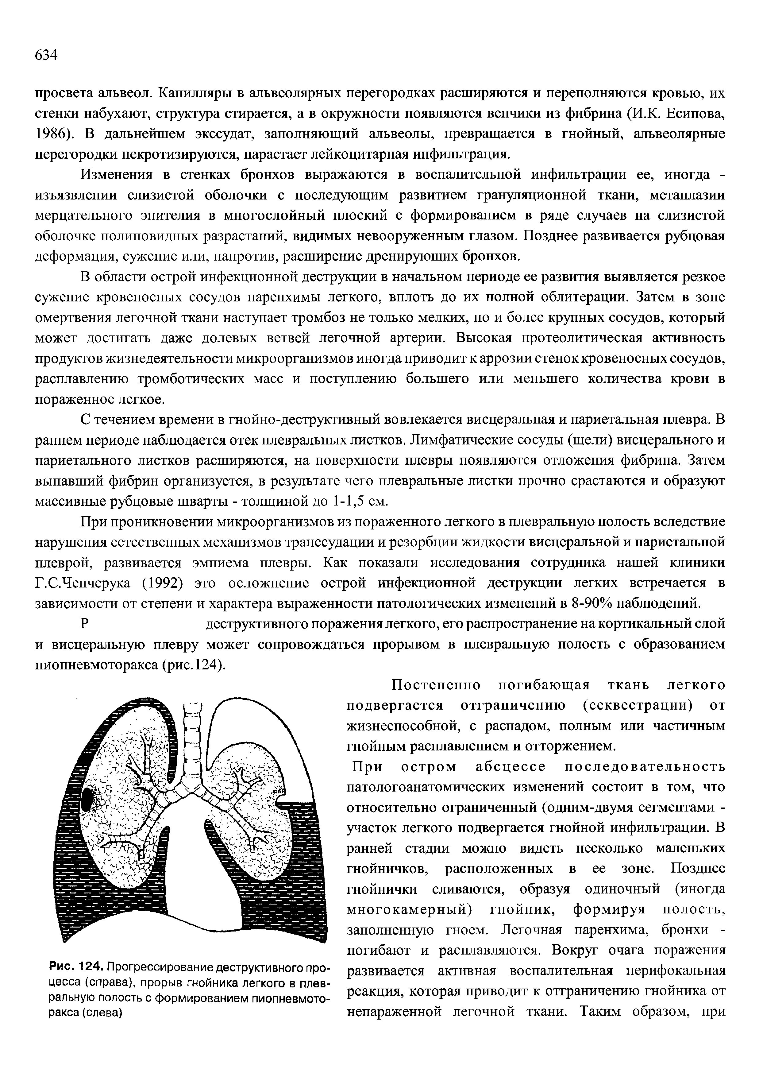 Рис. 124. Прогрессирование деструктивного процесса (справа), прорыв гнойника легкого в плевральную полость с формированием пиопневмоторакса (слева)...