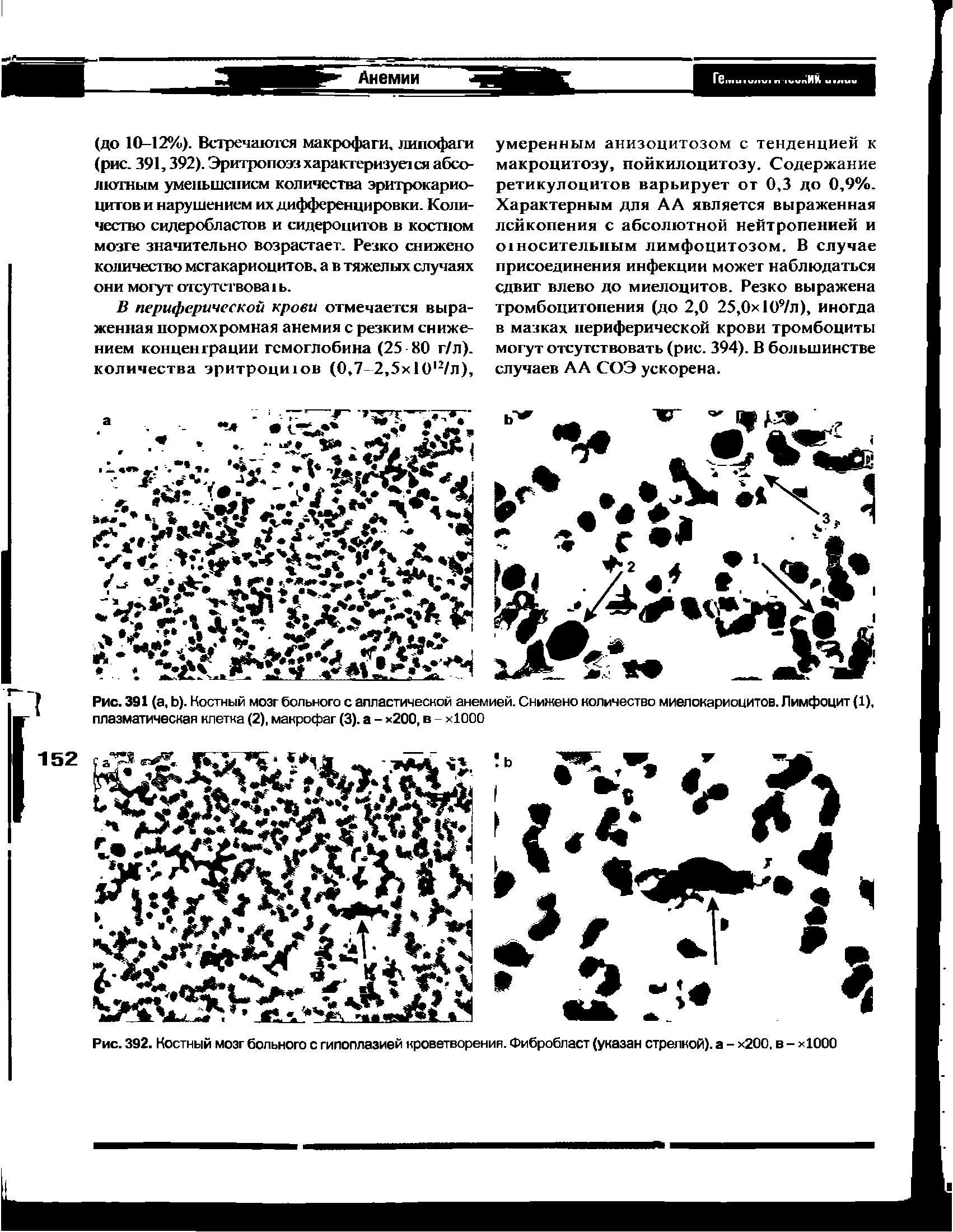 Рис. 392. Костный мозг больного с гипоплазией кроветворения. Фибробласт (указан стрелкой), а - х200, в - хЮОО...