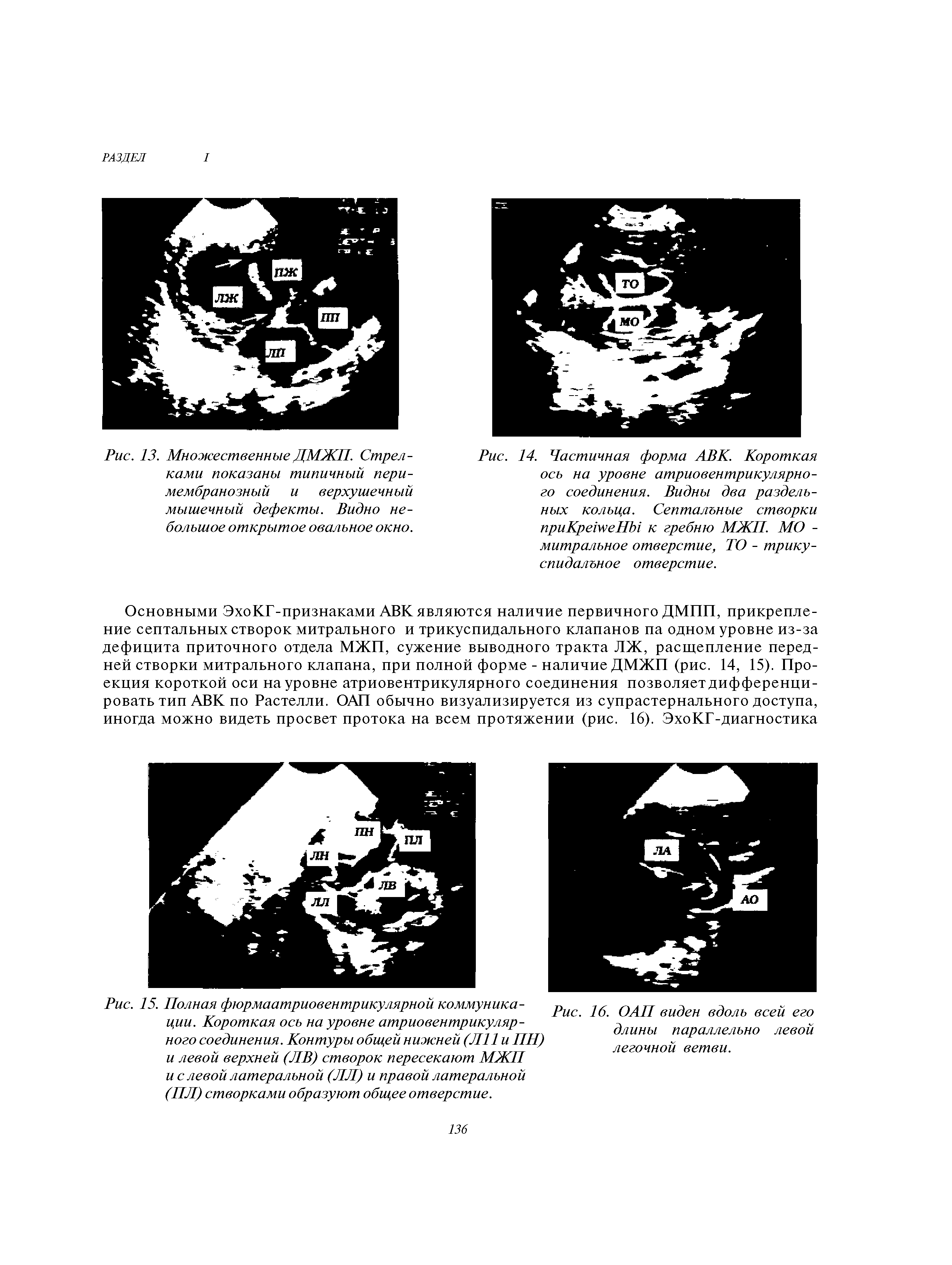 Рис. 15. Полная фюрмаатриовентрикулярной коммуникации. Короткая ось на уровне атриовентрикулярного соединения. Контуры общей нижней (Л11 и ПН) и левой верхней (ЛВ) створок пересекают МЖП и с левой латеральной (ЛЛ) и правой латеральной (ПЛ) створками образуют общее отверстие.