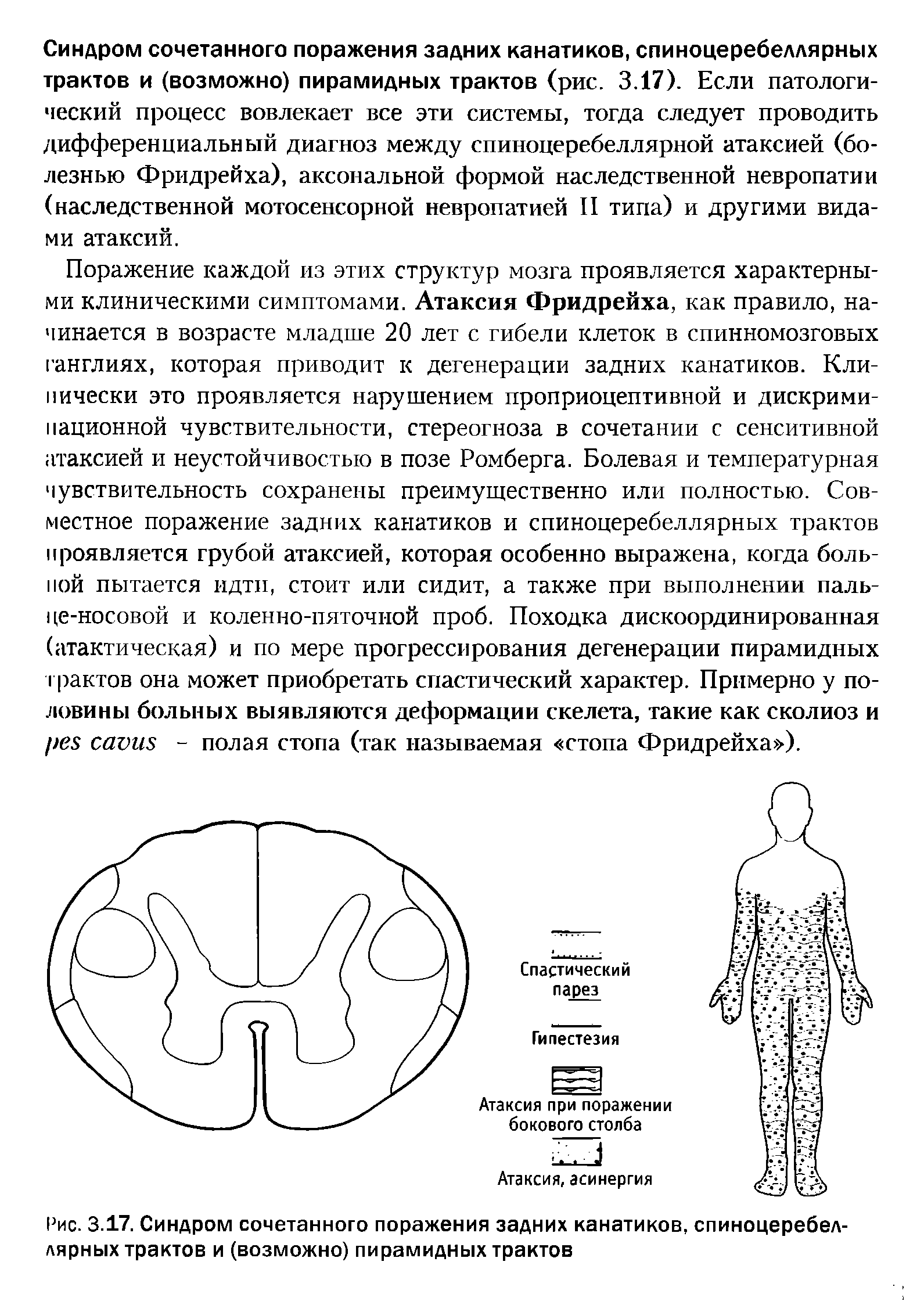 Рис. 3.17. Синдром сочетанного поражения задних канатиков, спиноцеребеллярных трактов и (возможно) пирамидных трактов...