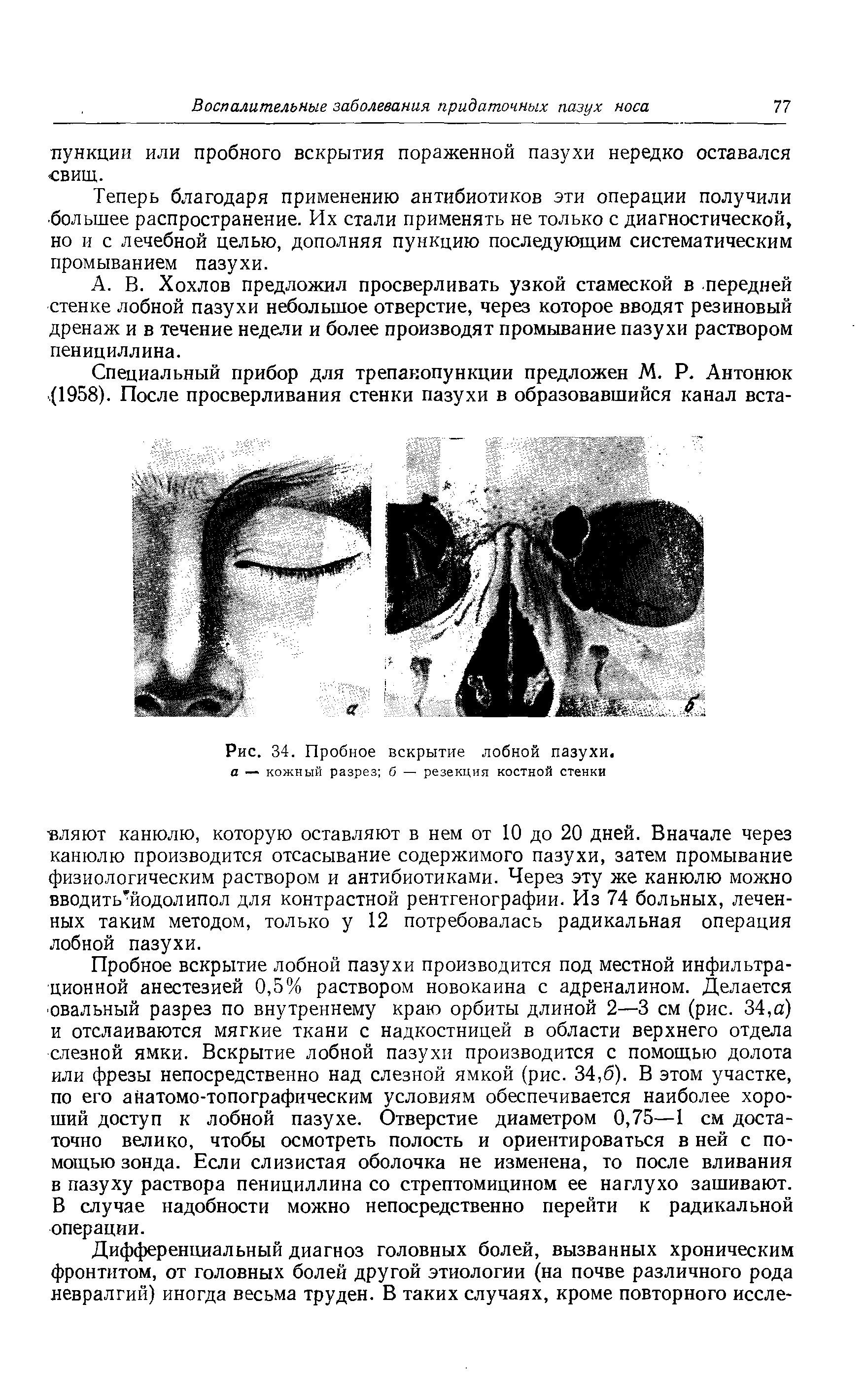 Рис. 34. Пробное вскрытие лобной пазухи. а — кожный разрез б — резекция костной стенки...