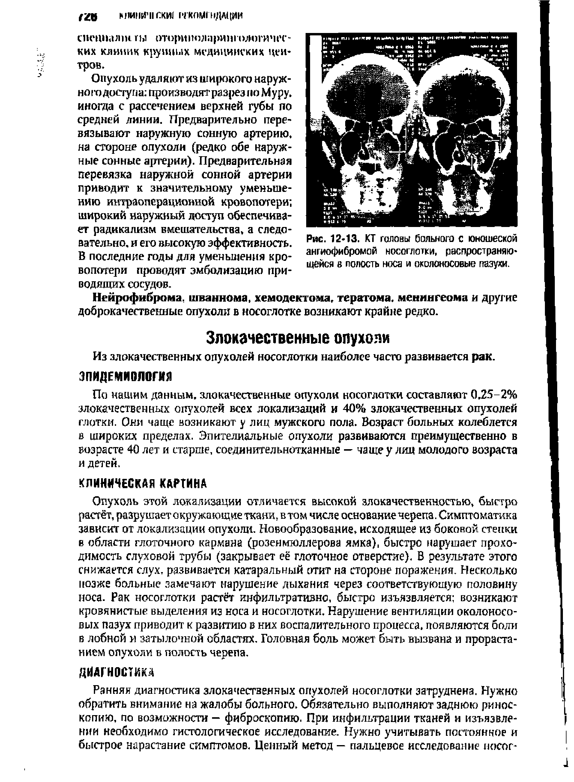 Рис. 12-13. КТ головы больного с юношеской ангиофибромой носоглотки, распространяющейся в полость носа и околоносовые пазухи.