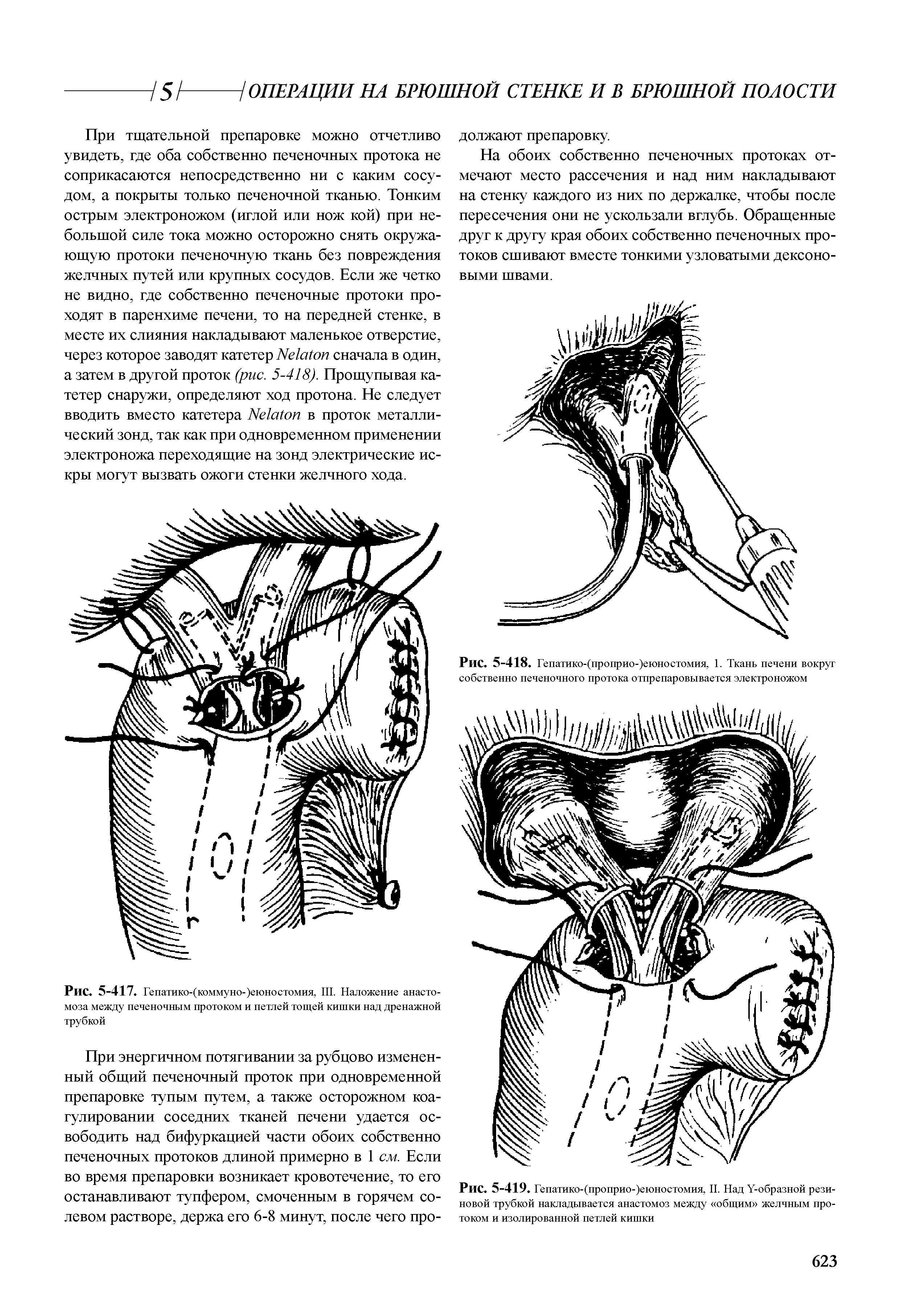 Рис. 5-417. Гепатико-(коммуно-)еюностомия, III. Наложение анастомоза между печеночным протоком и петлей тощей кишки над дренажной трубкой...