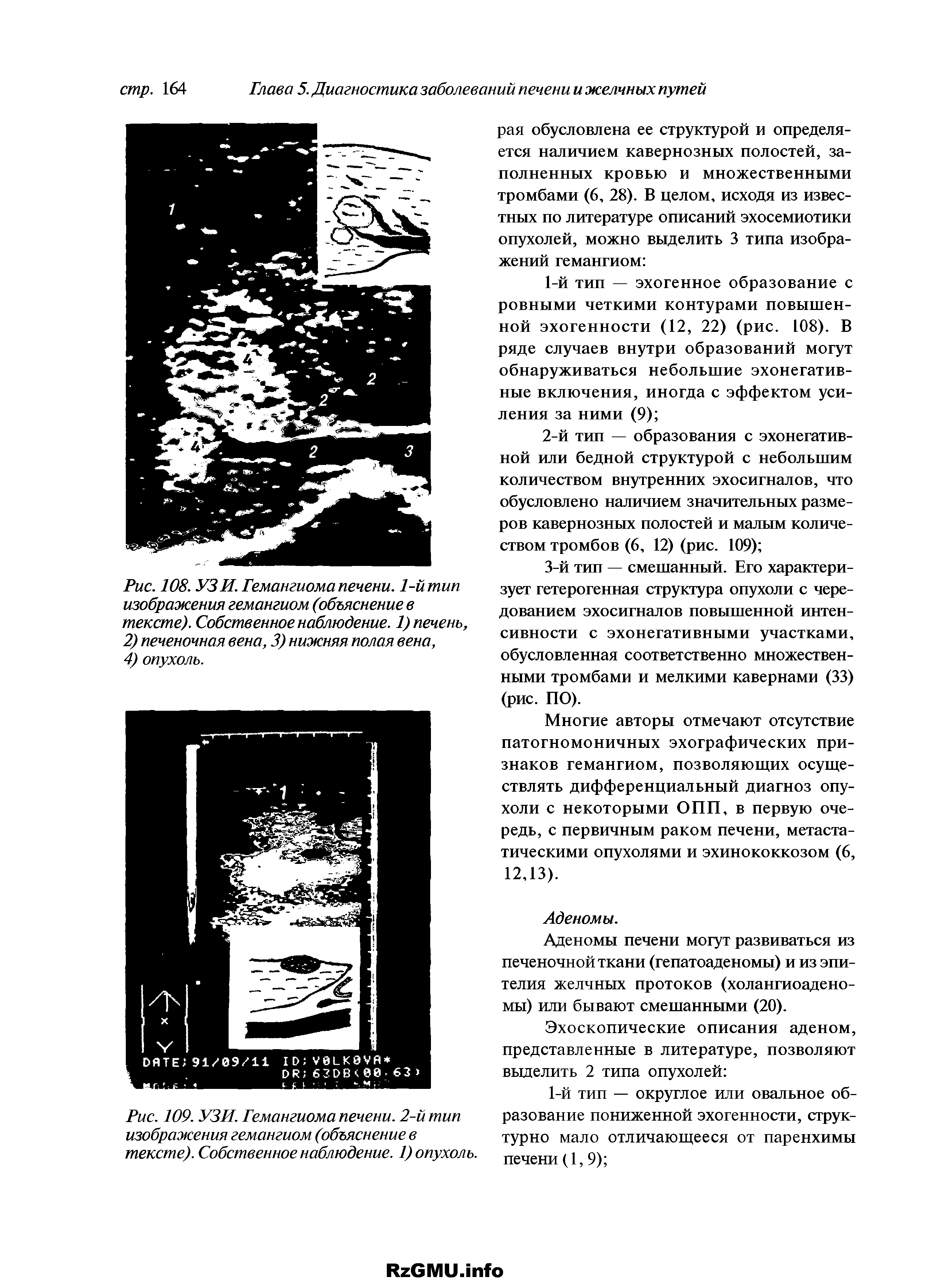 Рис. 108. УЗИ. Гемангиома печени. 1-й тип изображения гемангиом (объяснение в тексте). Собственное наблюдение. 1) печень, 2) печеночная вена, 3) нижняя полая вена, 4) опухоль.