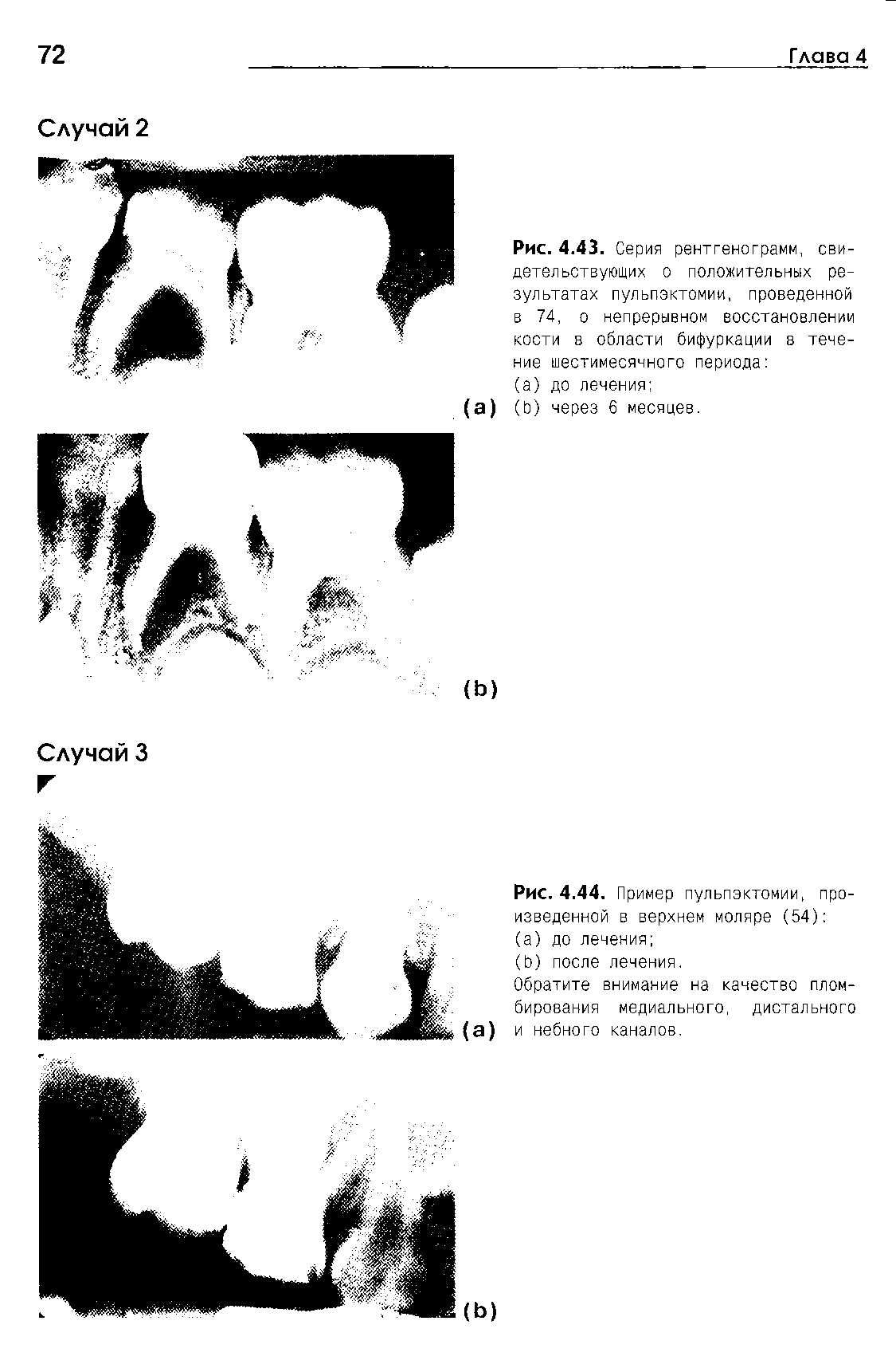 Рис. 4.43. Серия рентгенограмм, свидетельствующих о положительных результатах пульпэктомии, проведенной в 74, о непрерывном восстановлении кости в области бифуркации в течение шестимесячного периода ...