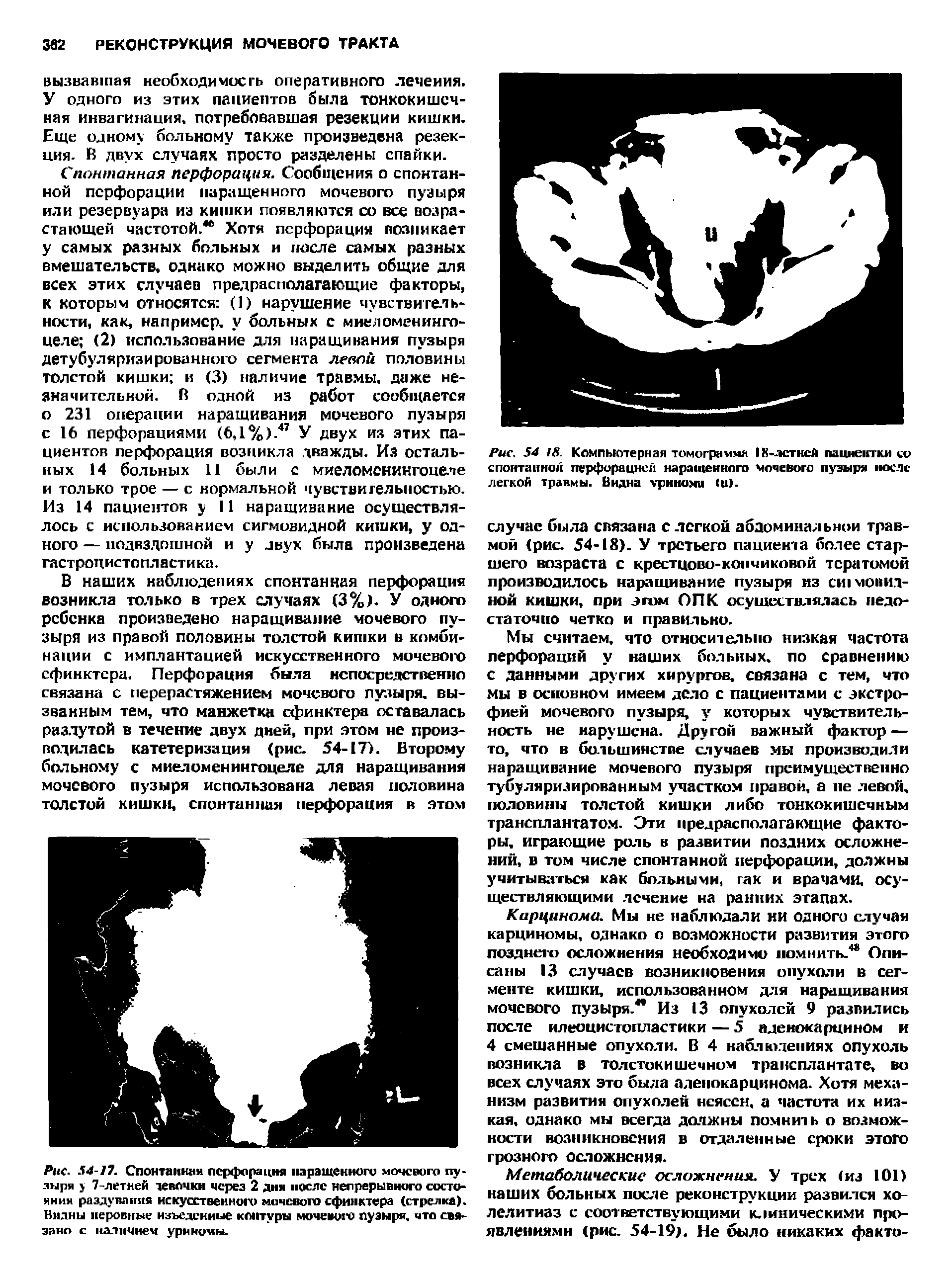 Рис. 54 18. Компьютерная томограмма 1Х-лстнсй пациентки со спонтанной перфорацией наращенного мочевого пузыря после легкой травмы. Видна уриномв 1и).