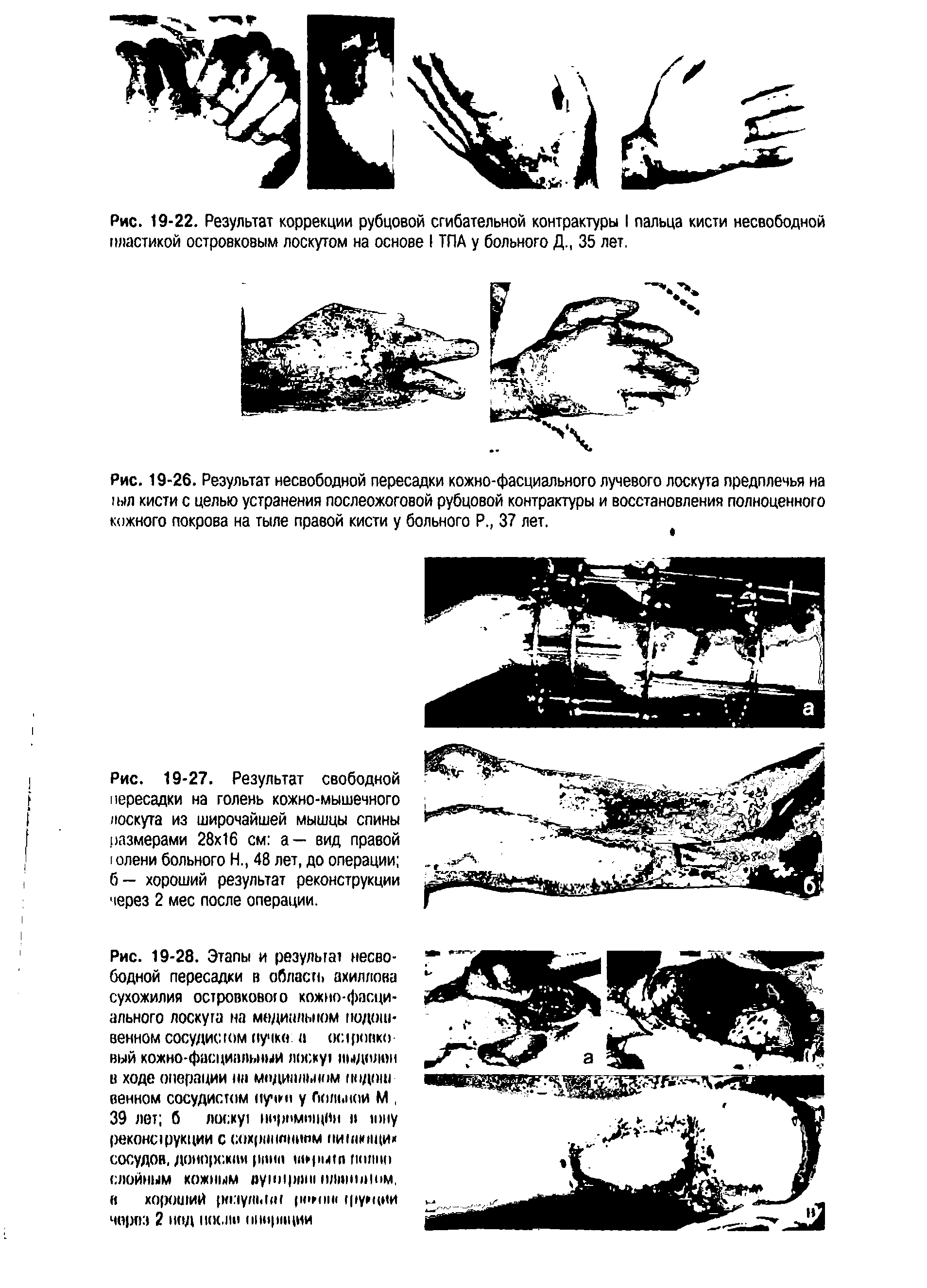 Рис. 19-27. Результат свободной пересадки на голень кожно-мышечного лоскута из широчайшей мышцы спины размерами 28 16 см а— вид правой олени больного Н., 48 лет, до операции б— хороший результат реконструкции через 2 мес после операции.