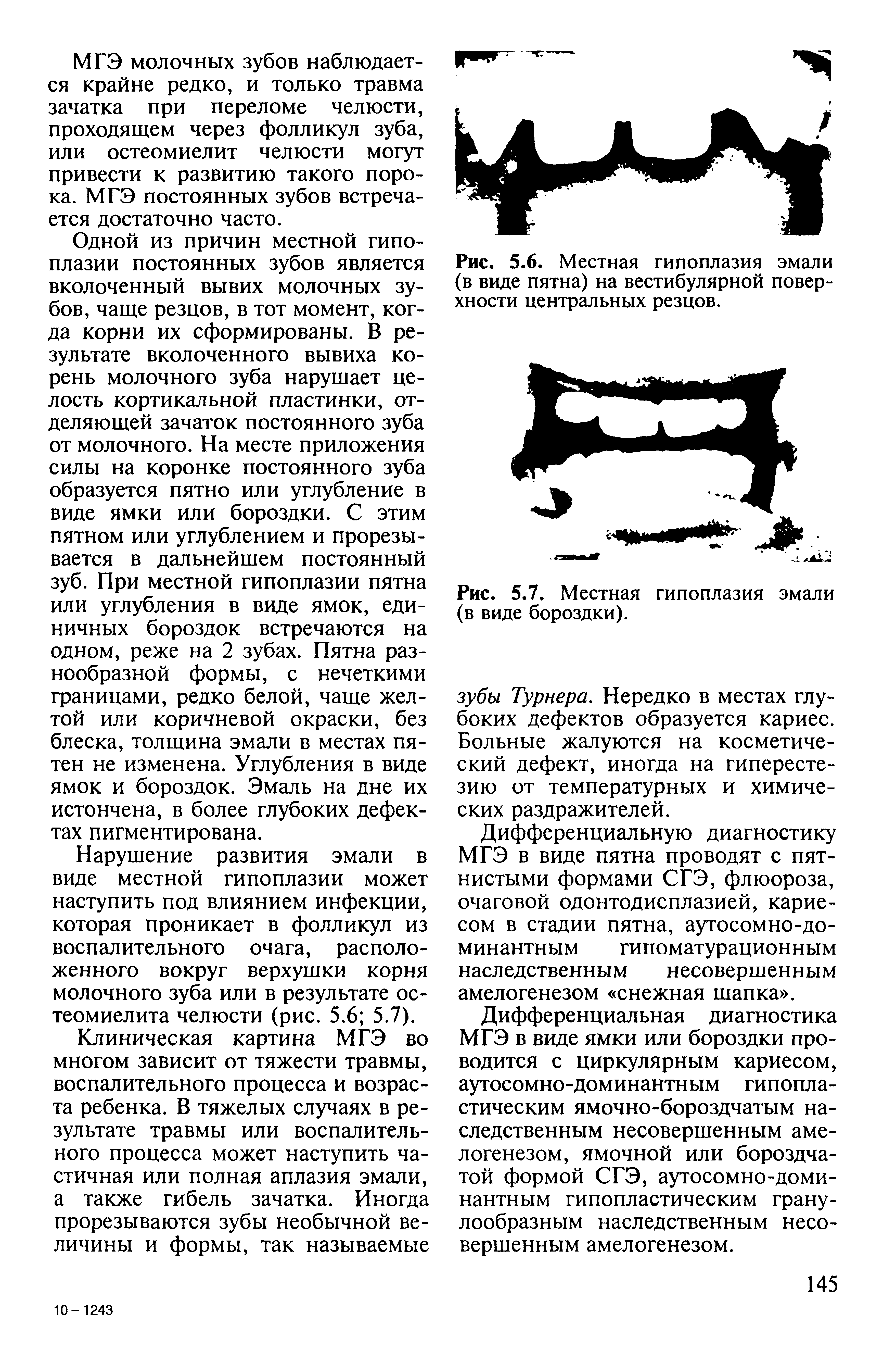 Рис. 5.6. Местная гипоплазия эмали (в виде пятна) на вестибулярной поверхности центральных резцов.