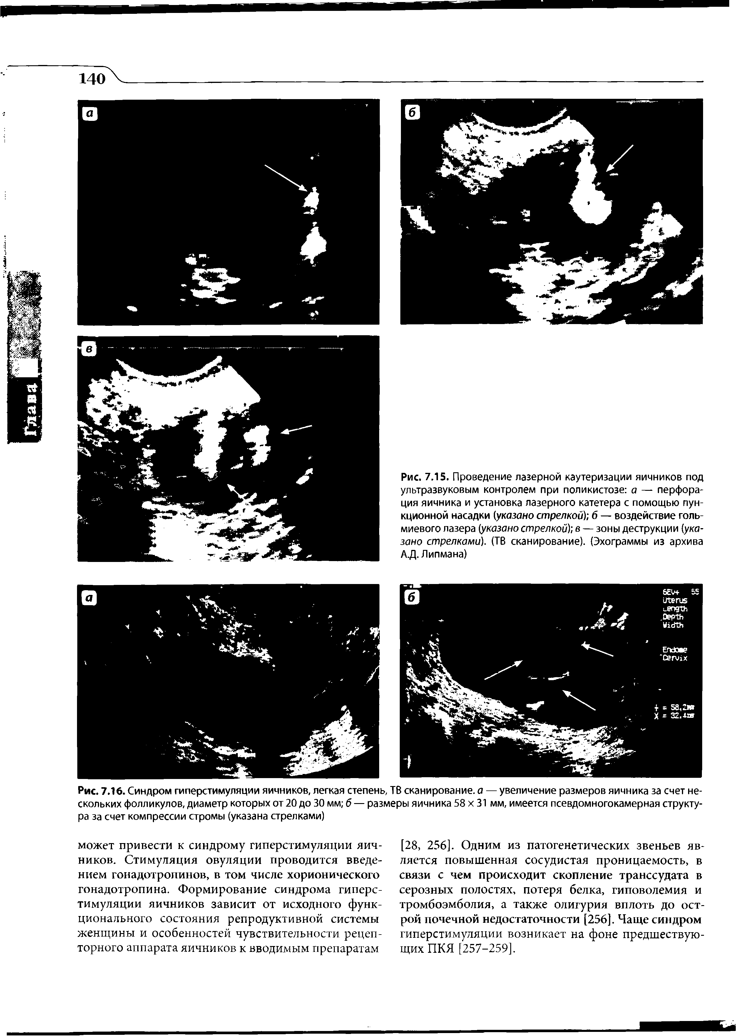 Рис. 7.16. Синдром гиперстимуляции яичников, легкая степень, ТВ сканирование, а — увеличение размеров яичника за счет нескольких фолликулов, диаметр которых от 20 до 30 мм б — размеры яичника 58 х 31 мм, имеется псевдомногокамерная структура за счет компрессии стромы (указана стрелками)...