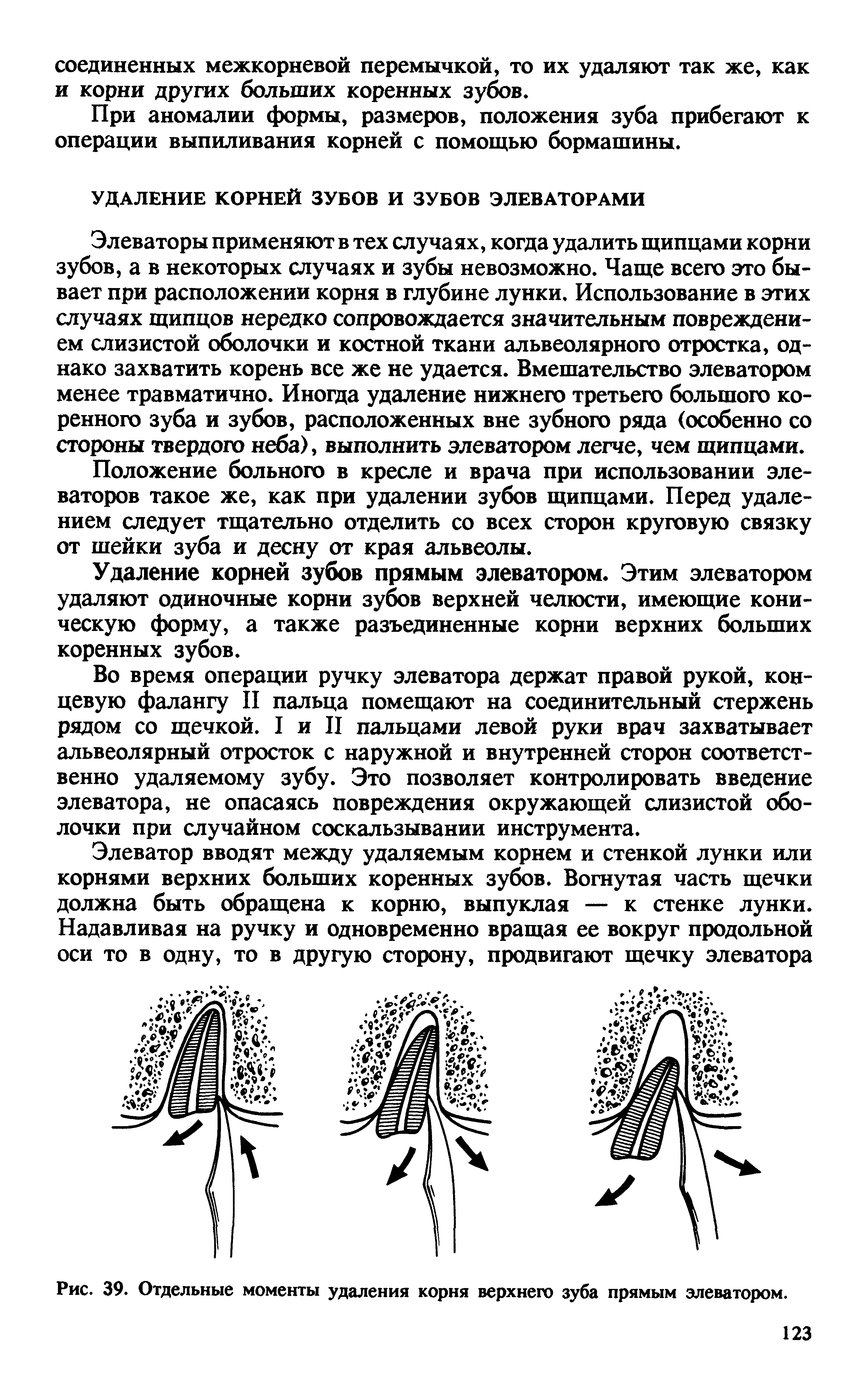 Рис. 39. Отдельные моменты удаления корня верхнего зуба прямым элеватором.