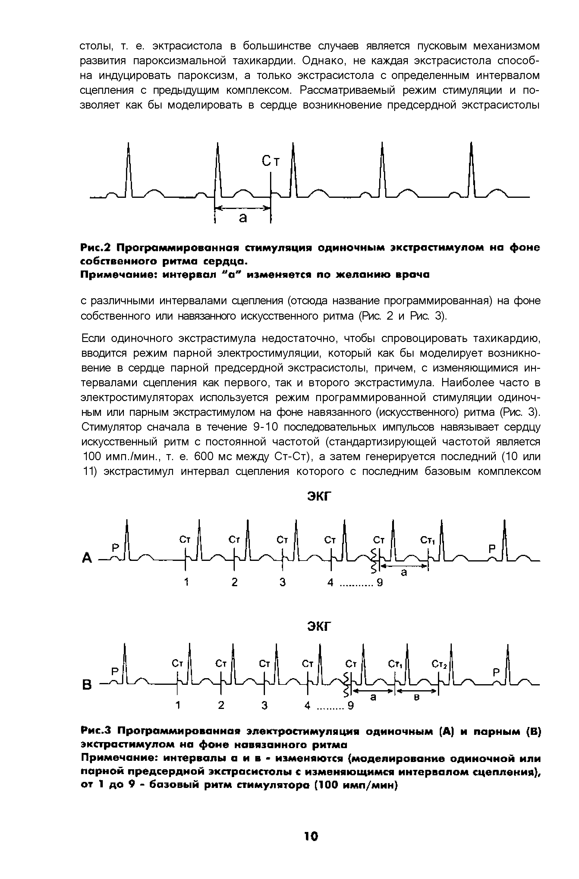 Рис.З Программированная электростимуляция одиночным (А) и парным (В) экстра стимулом на фоне навязанного ритма...