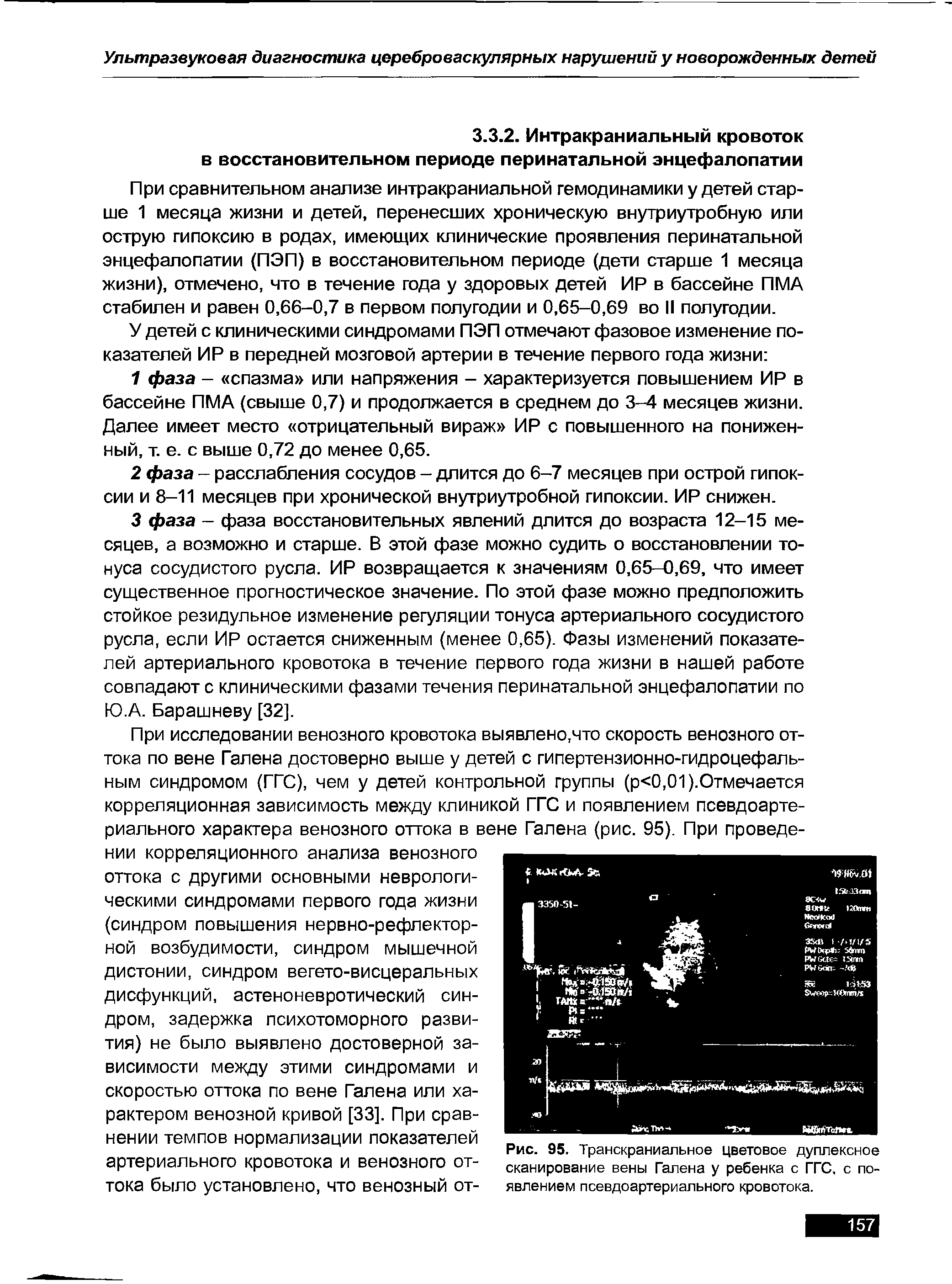 Рис. 95. Транскраниальное цветовое дуплексное сканирование вены Галена у ребенка с ГГС, с появлением псевдоартериального кровотока.