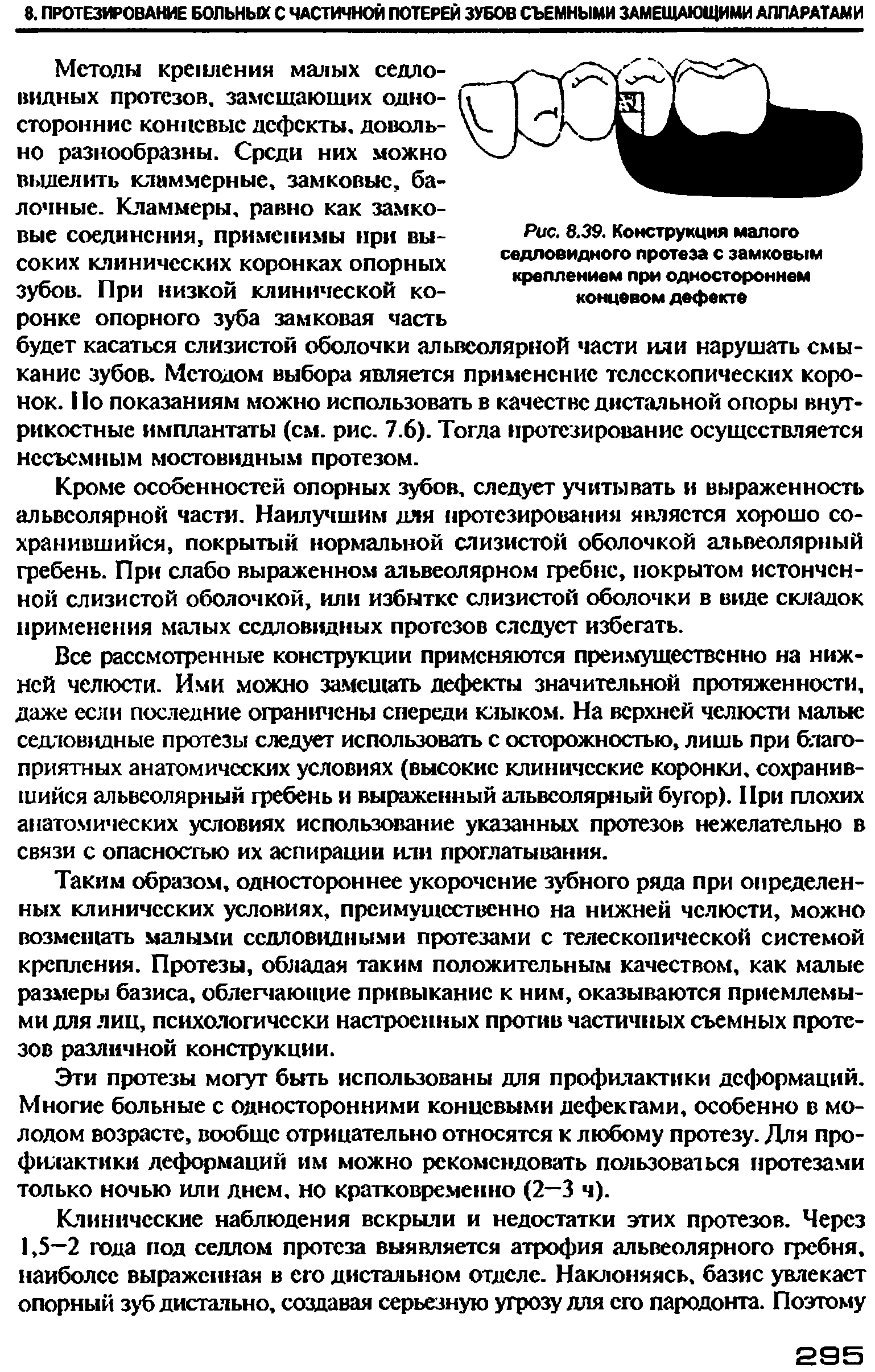 Рис. 8.39. Конструкция малого седловидного протеза с замковым креплением при одностороннем концевом дефекте...