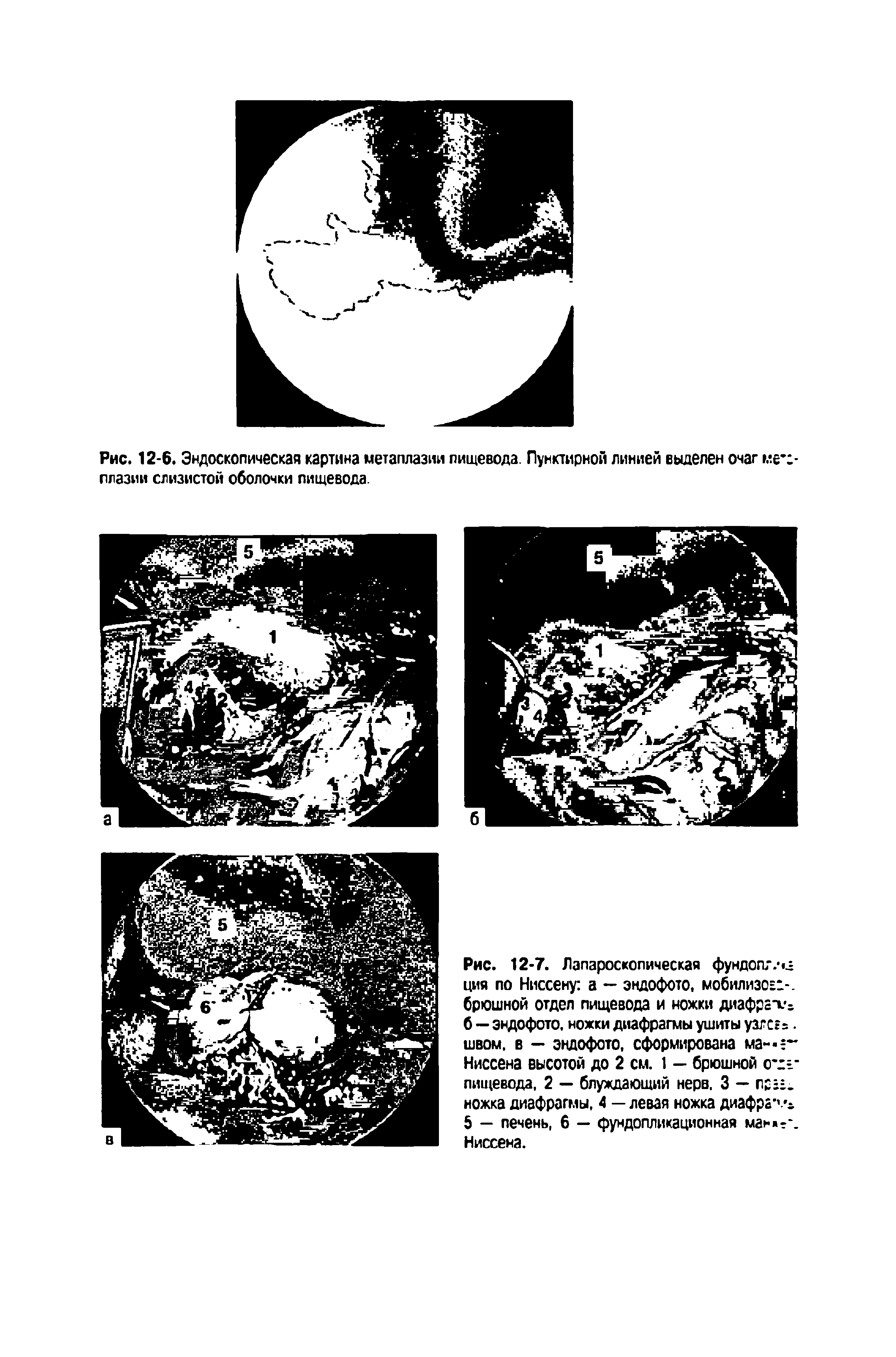 Рис. 12-7. Лапароскопическая фундогъ-.1 ция по Ниссену а — эндофото, мобилизо=>. брюшной отдел пищевода и ножки диафратг б — эндофото, ножки диафрагмы ушиты узгсг=. швом, в — эндофото, сформирована ма Ниссена высотой до 2 см. 1 — брюшной с - пищевода, 2 — блуждающий нерв. 3 — пр. ножка диафрагмы, 4 — левая ножка диафрачч 5 — печень, 6 — фундопликационная ман --. Ниссена.