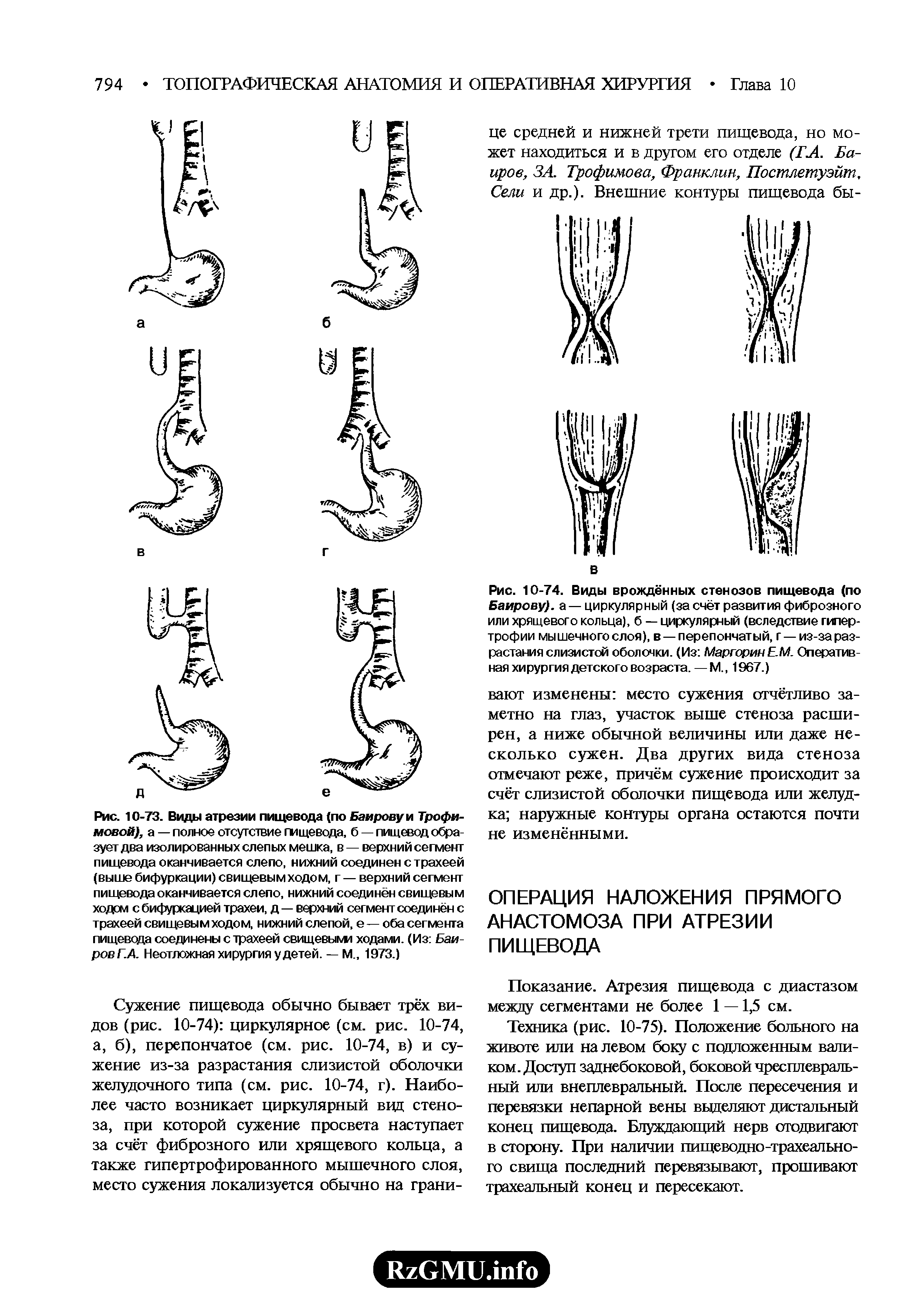 Рис. 10-74. Виды врождённых стенозов пищевода (по Баирову). а — циркулярный (за счёт развития фиброзного или хрящевого кольца), б — циркулярный (вследствие гипертрофии мышечного слоя), в —перепончатый, г —из-за разрастания слизистой оболочки. (Из МаргоринЕ.М. Оперативная хирургия детского возраста. — М., 1967.)...