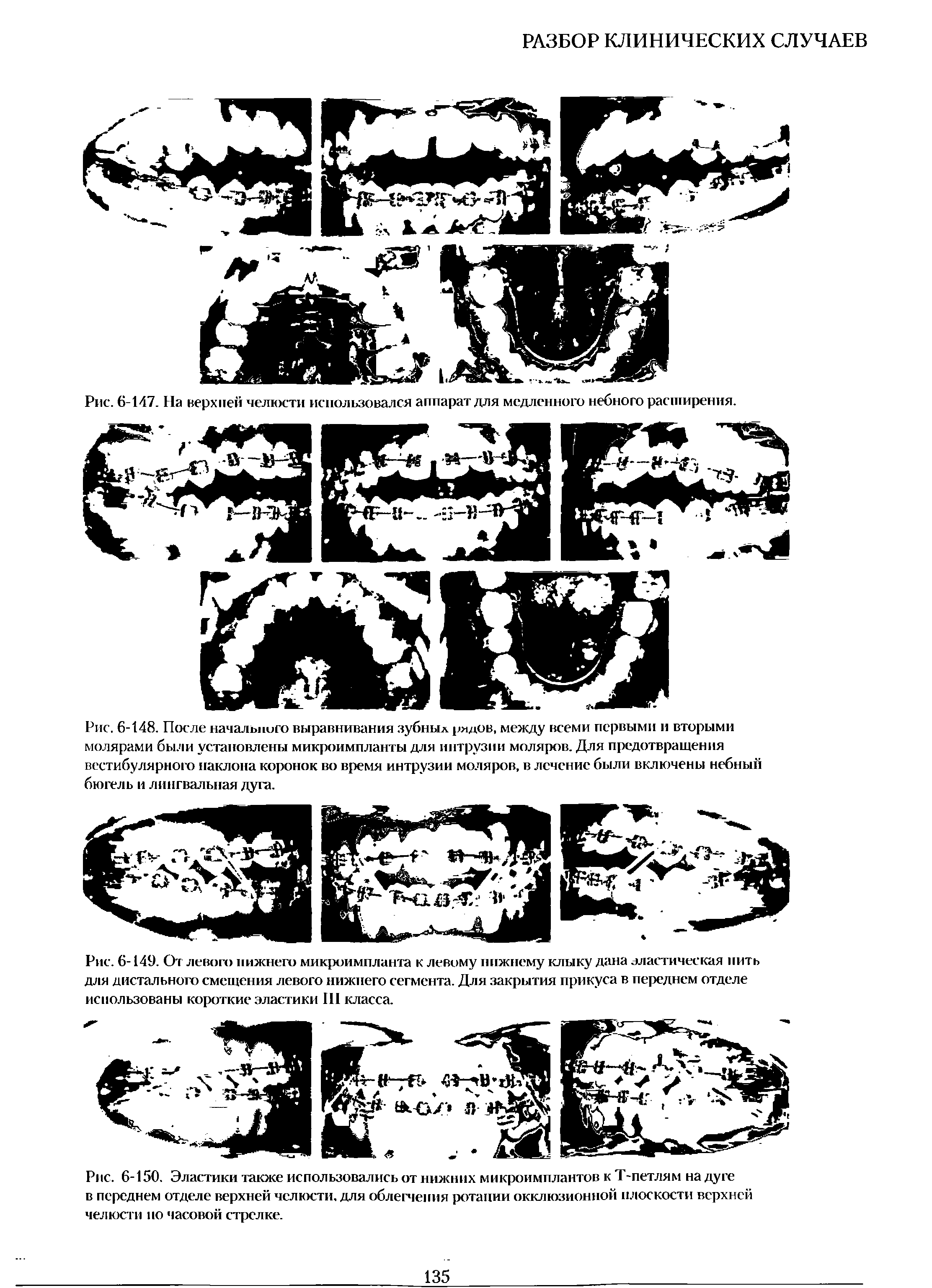 Рис. 6-150. Эластики также использовались от нижних микроимплантов к Т-петлям на дуге в переднем отделе верхней челюсти, для облегчения ротании окклюзионной плоскости верхней челюсти по часовой стрелке.