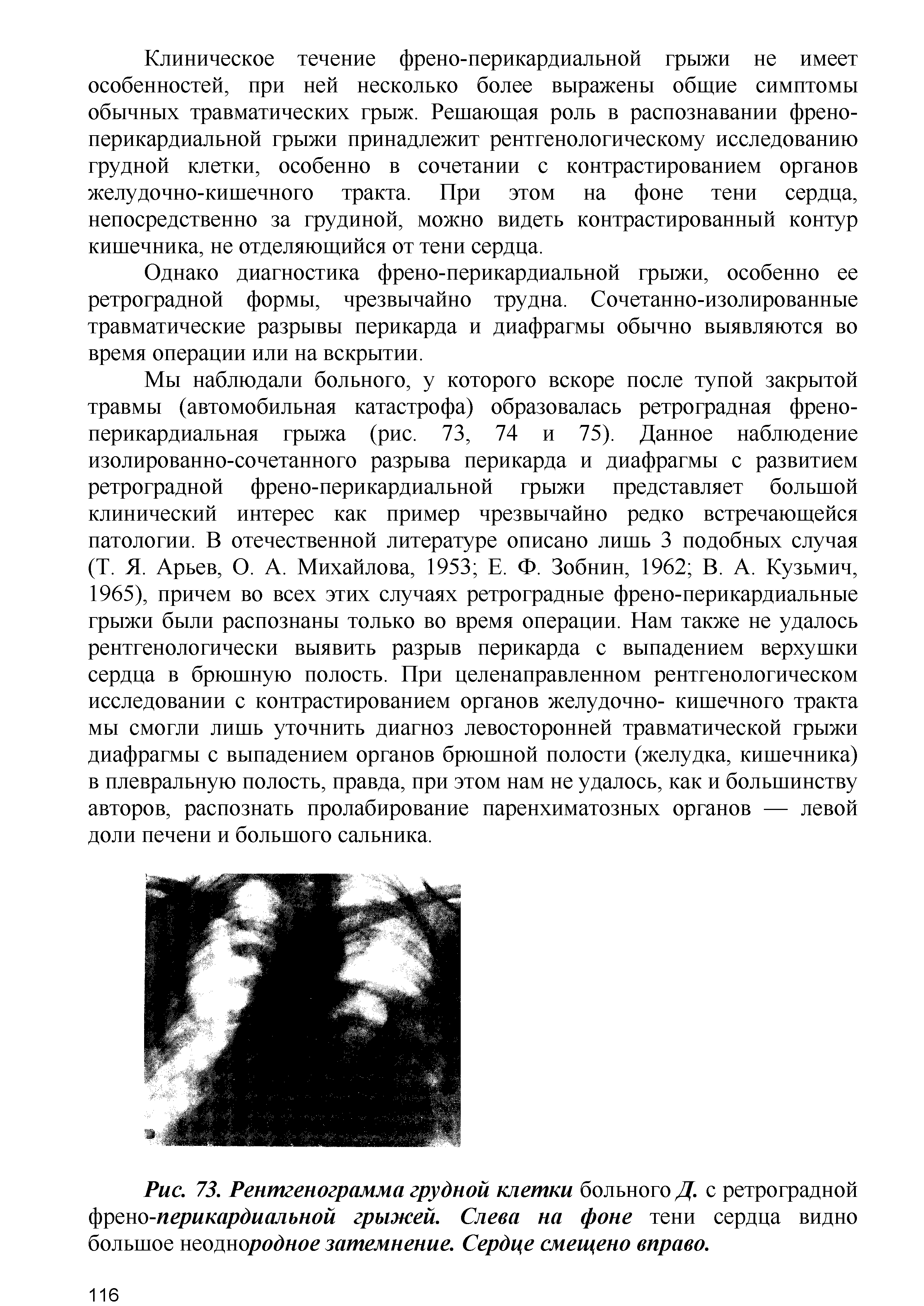 Рис. 73. Рентгенограмма грудной клетки больного Д. с ретроградной но-перикардиальной грыжей. Слева на фоне тени сердца видно большое неоднородное затемнение. Сердце смещено вправо.