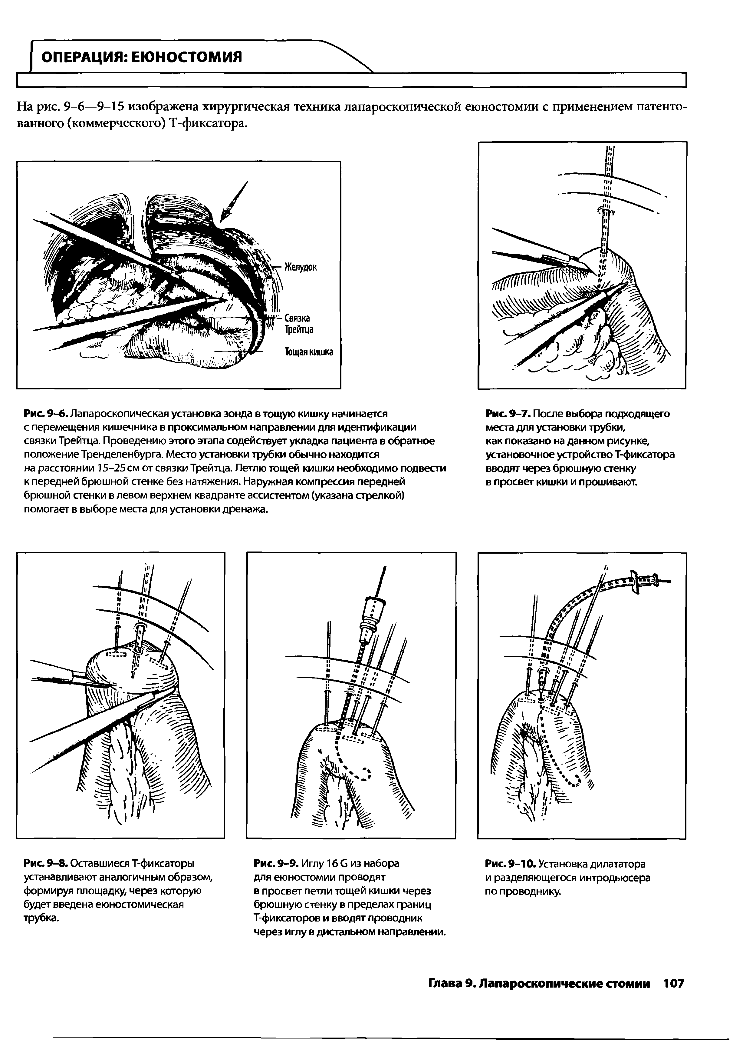 Рис. 9-8. Оставшиеся Т-фиксаторы устанавливают аналогичным образом, формируя площадку, через которую будет введена еюностомическая трубка.