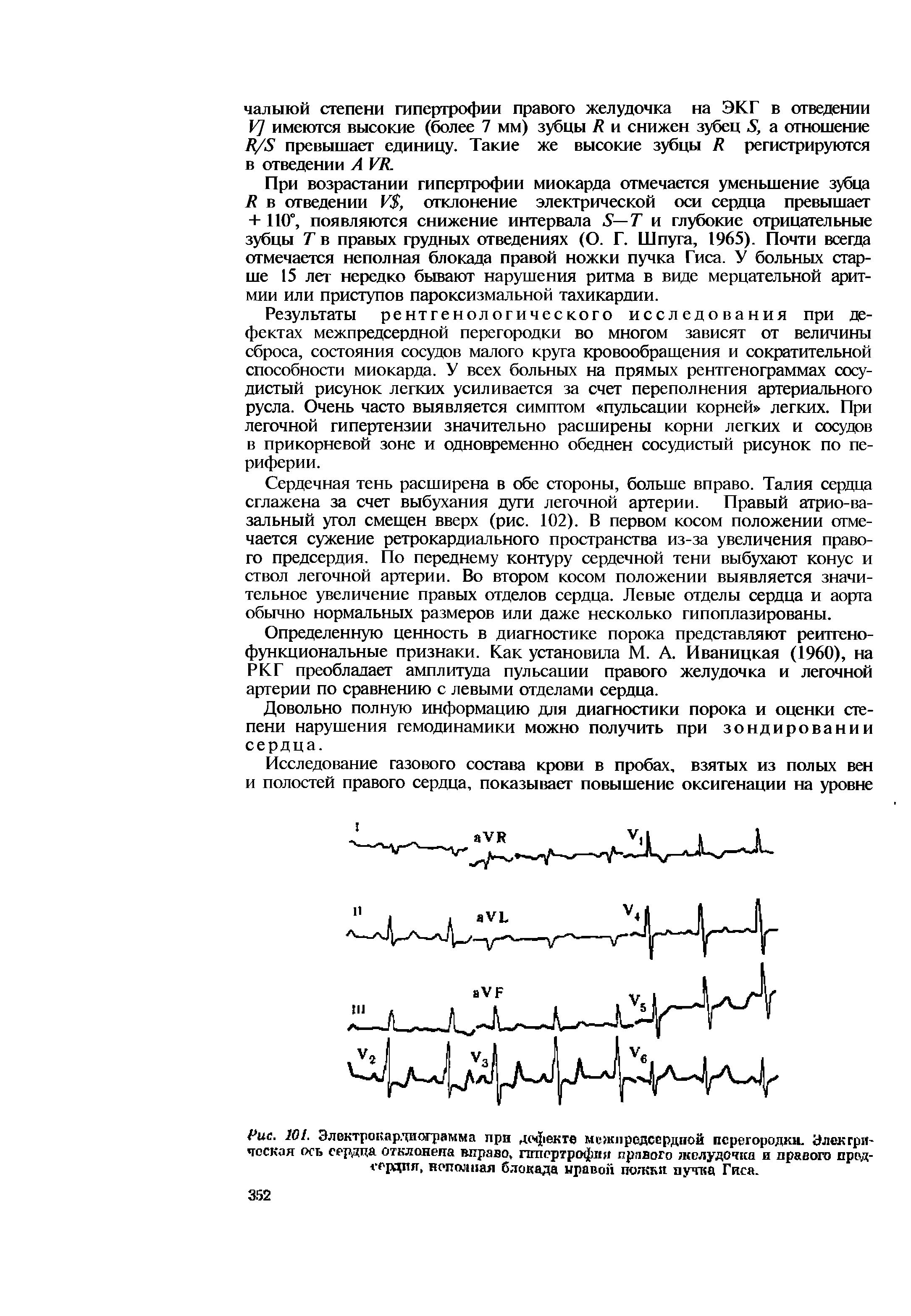 Рис. 101. Электрокардиограмма при дсч екте межпредсердной перегородки. Электрическая ось сердца отклонена вправо, гипертрофия правого желудочка и правого предсердии, неполная блокада правой по кки пучка Гиса.