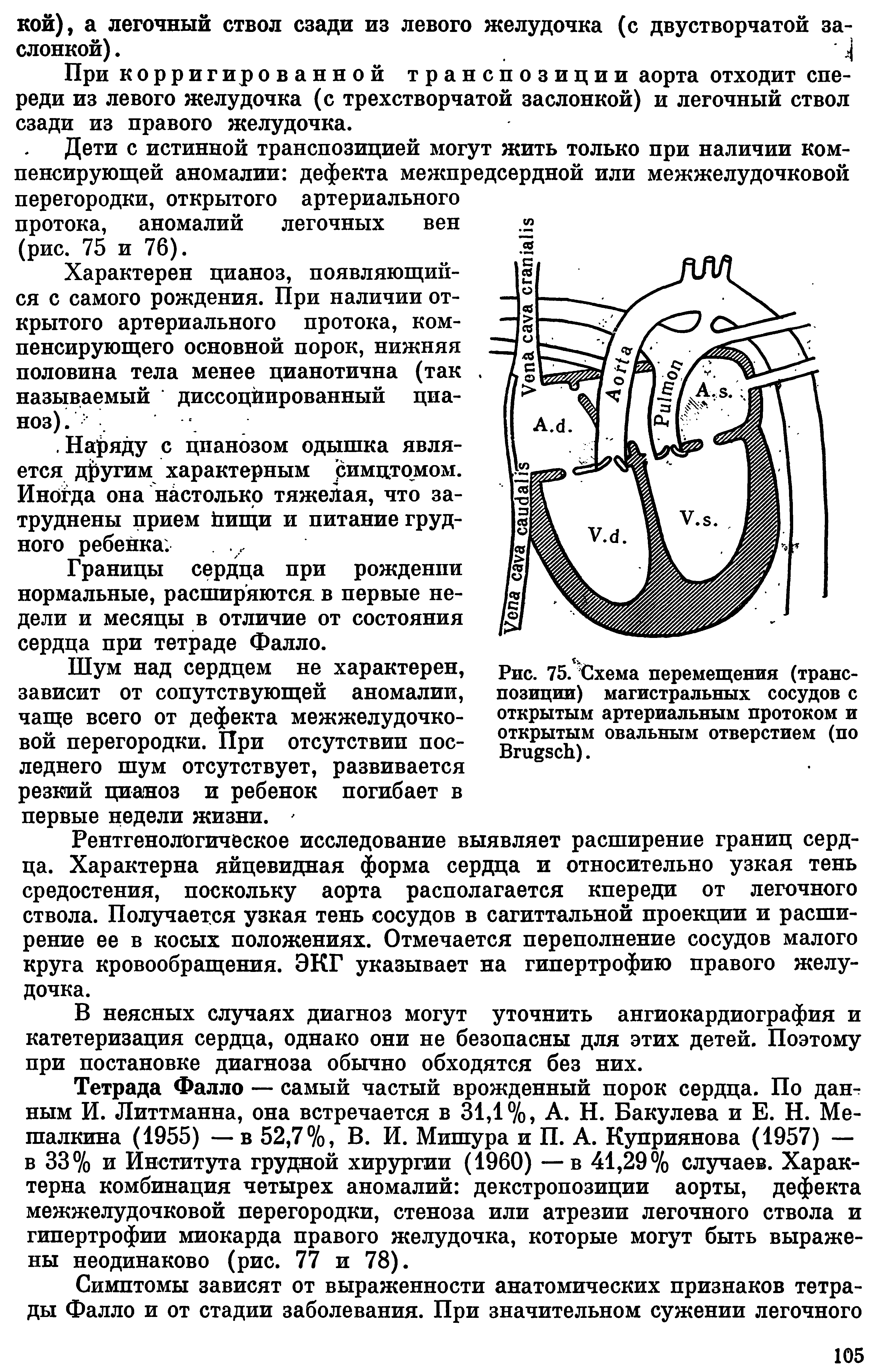 Рис. 75. Схема перемещения (транспозиции) магистральных сосудов с открытым артериальным протоком и открытым овальным отверстием (по ВпщэсЬ).