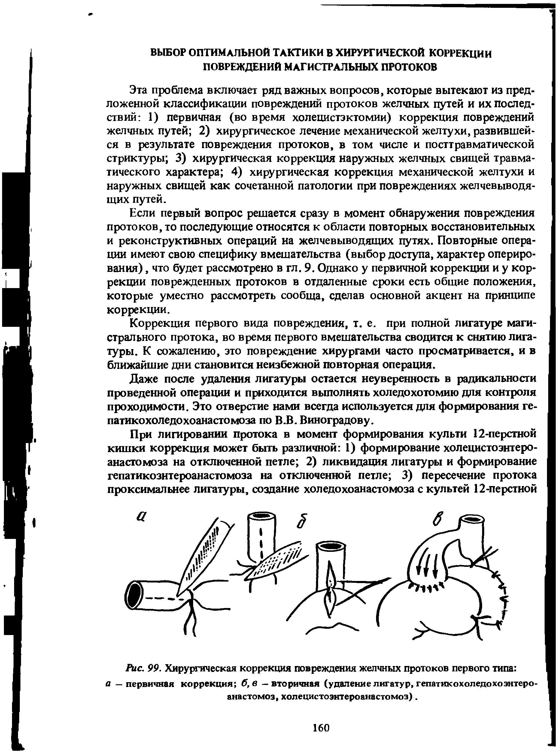 Рис. 99. Хирургическая коррекция повреждения желчных протоков первого типа а — первичная коррекция б, в — вторичная (удаление лигатур, гепатикохоледохоэнтеро анастомоз, холецистоэнтероанастомоз).