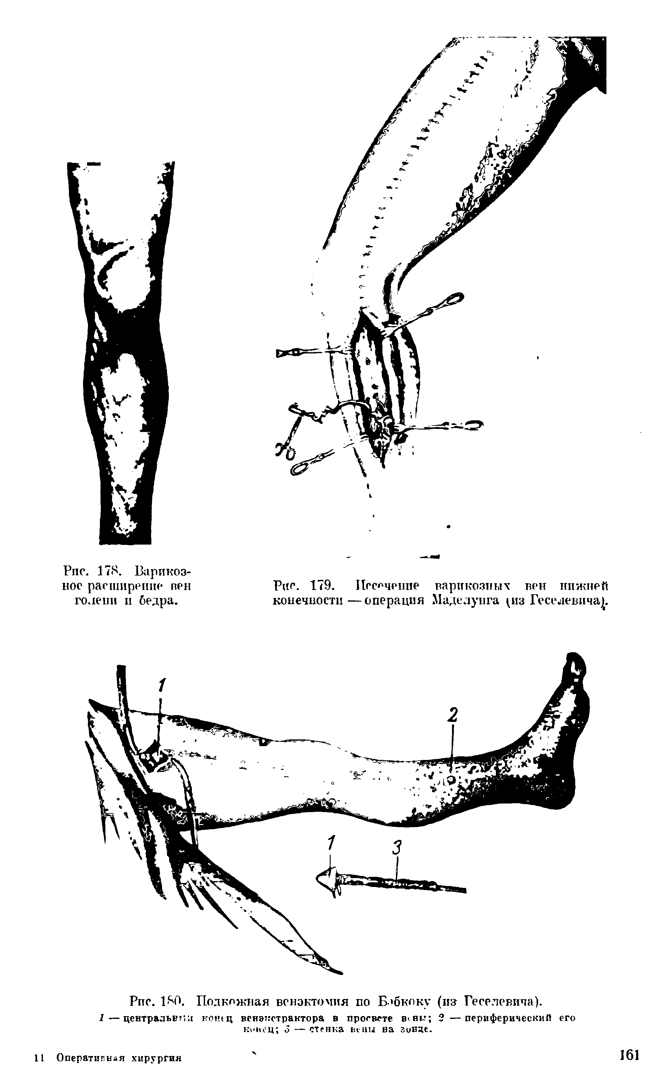 Рис. 179. Иссечение варикозных вен нижней конечности—операция Маделунга из Геселевича. ...