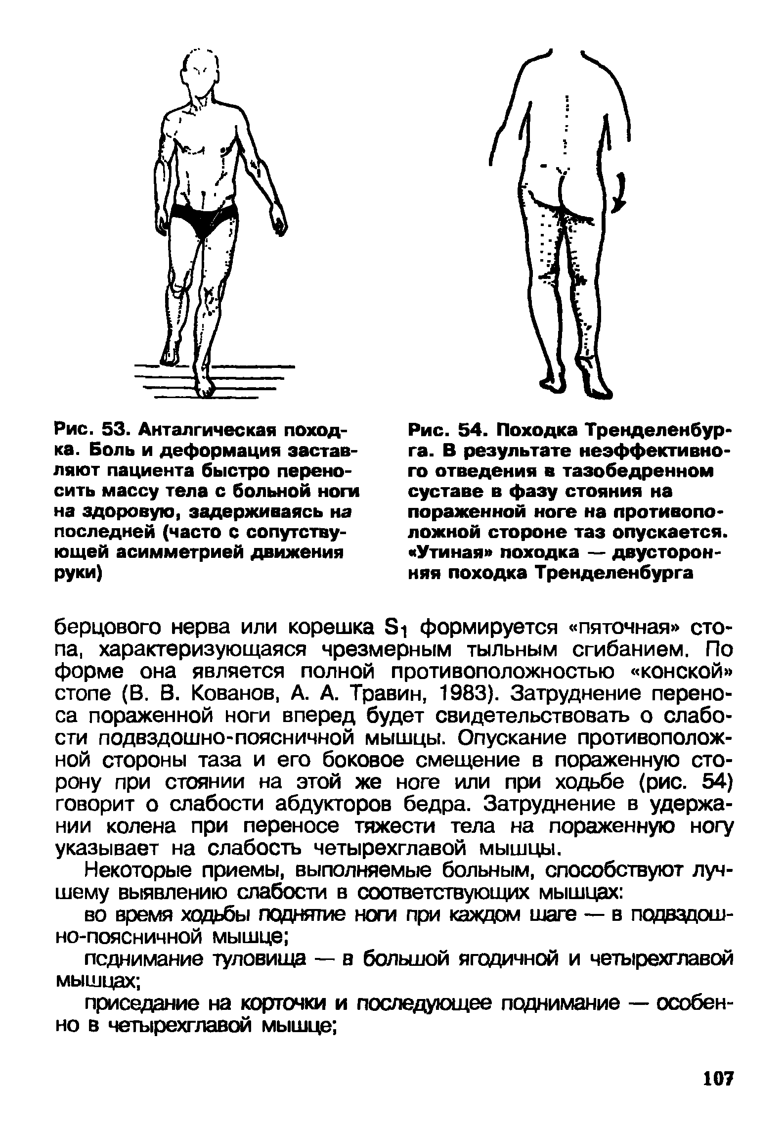 Рис. 54. Походка Тренделенбур-га. В результате неэффективного отведения в тазобедренном суставе в фазу стояния на пораженной ноге на противоположной стороне таз опускается. Утиная походка — двусторонняя походка Тренделенбурга...